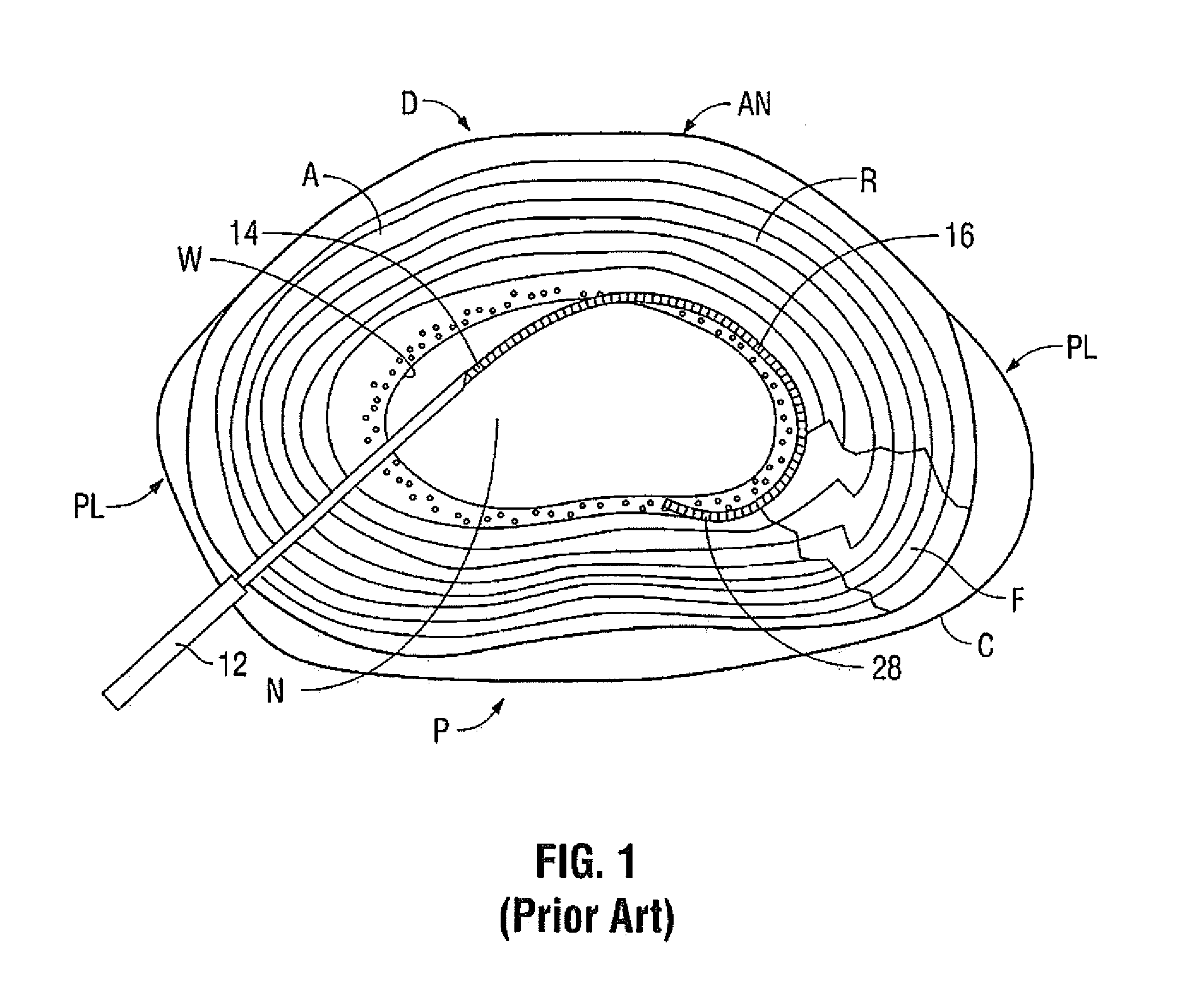 Method for Treatment of an Intervertebral Disc