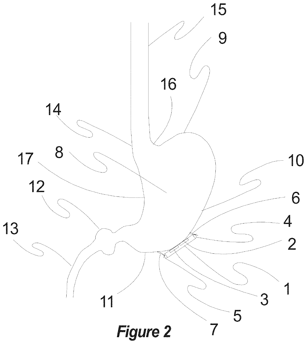 Method, apparatus, surgical technique, and optimal stimulation parameters for noninvasive & minimally invasive autonomic vector neuromodulation for physiologic optimization and for the treatment of adult respiratory distress syndrome (ARDS) and covid-19, and other conditions