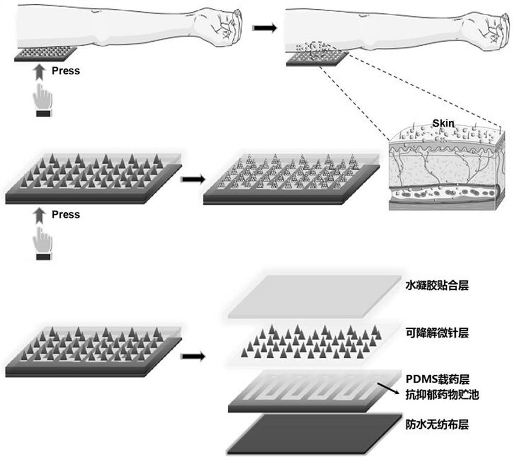 Long-acting depression relieving microneedle patch and preparation method thereof