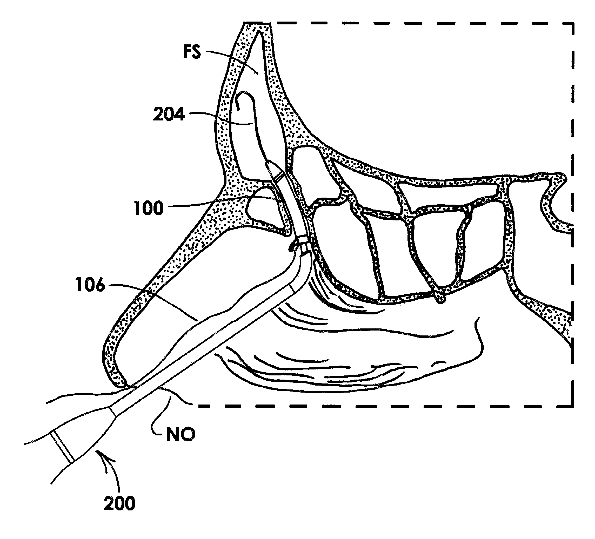 Frontal Sinus Recess Dilator