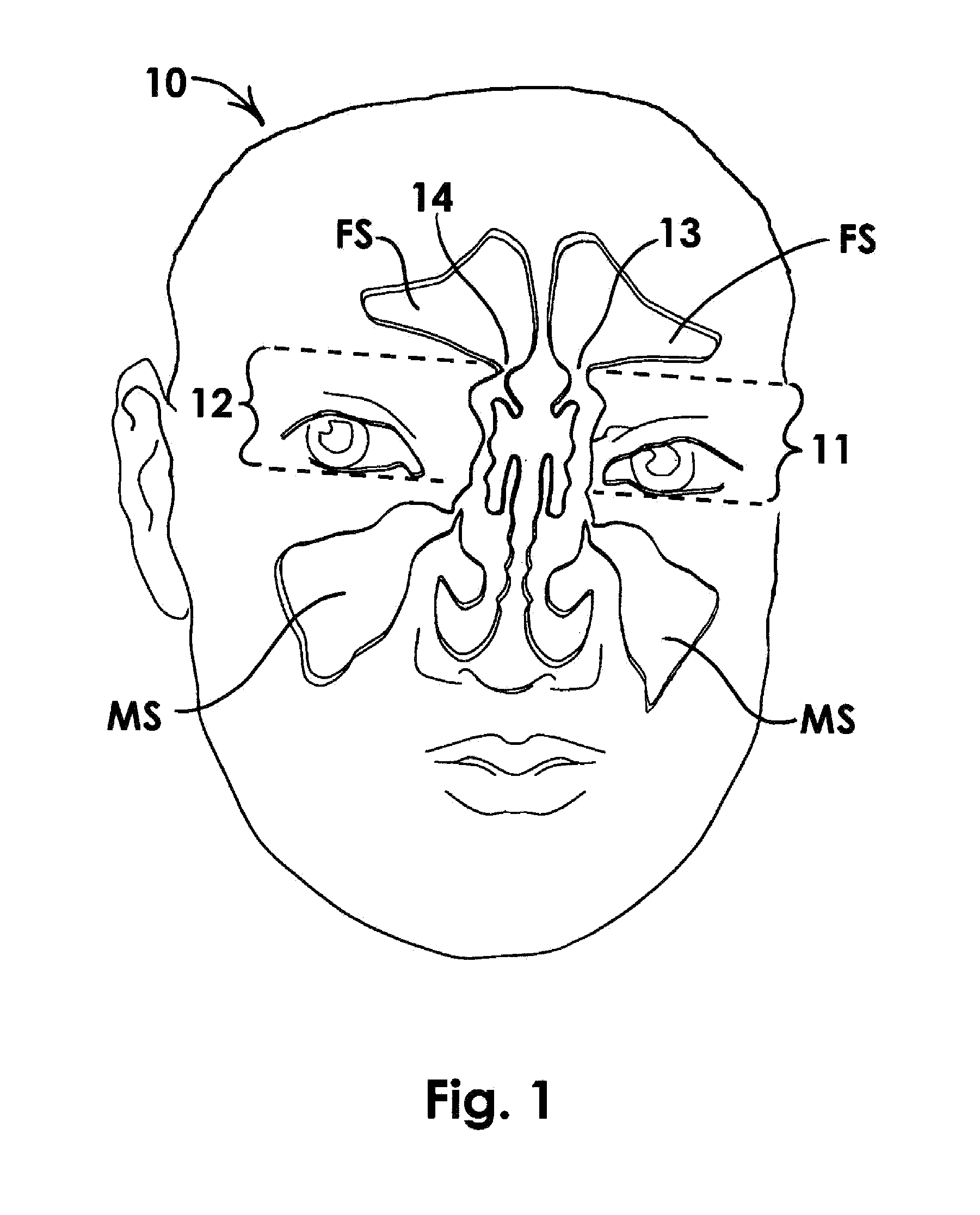 Frontal Sinus Recess Dilator