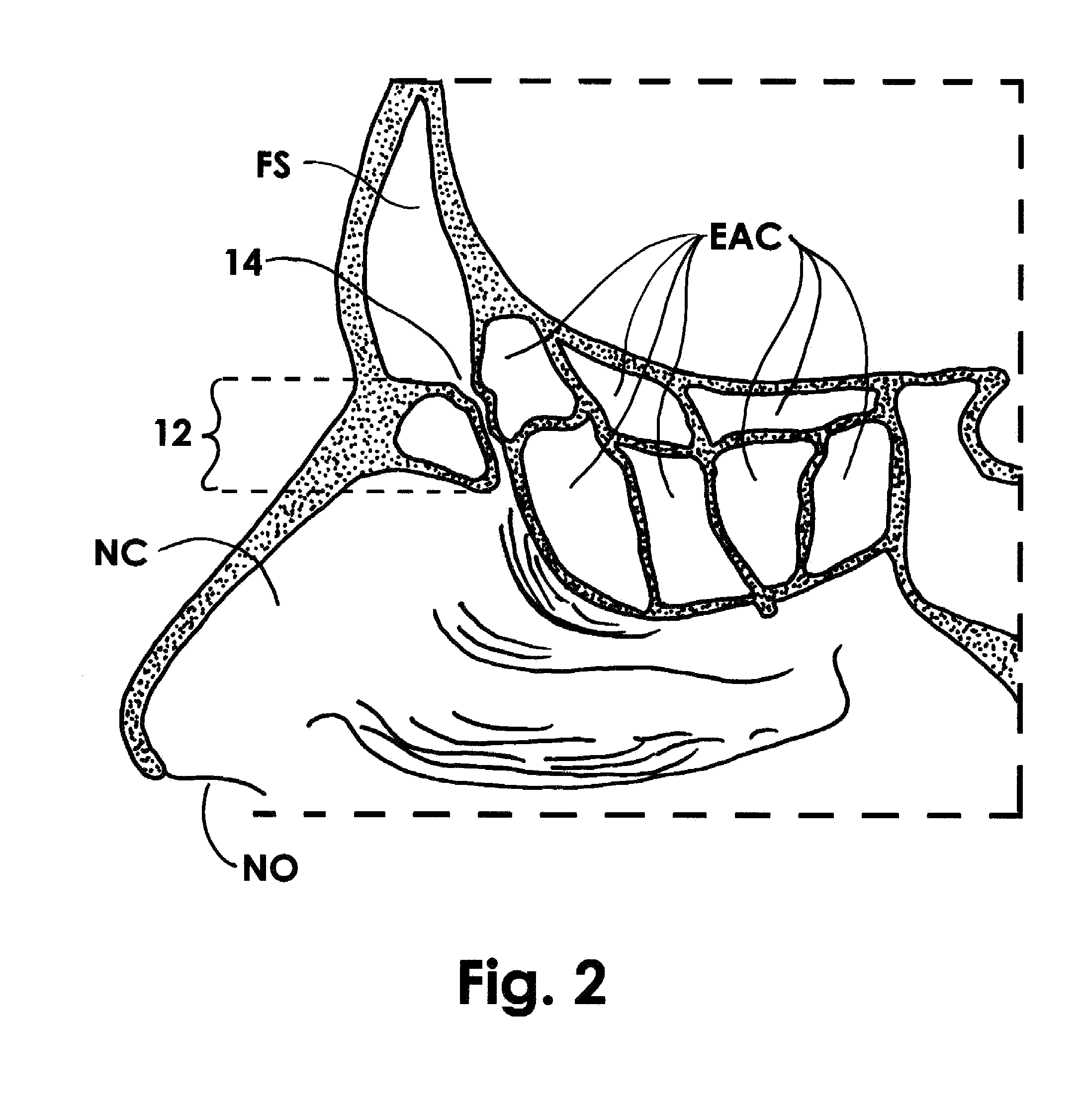 Frontal Sinus Recess Dilator