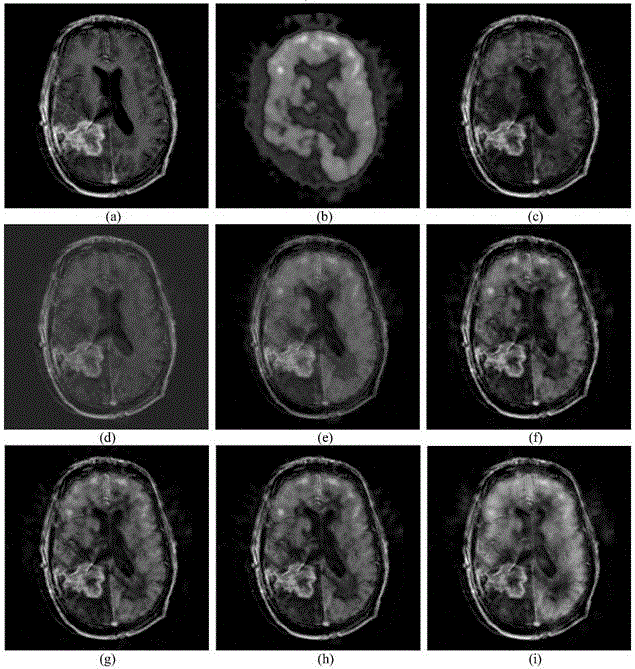 Multimodal medical image fusion method in contourlet domain based on statistical modeling