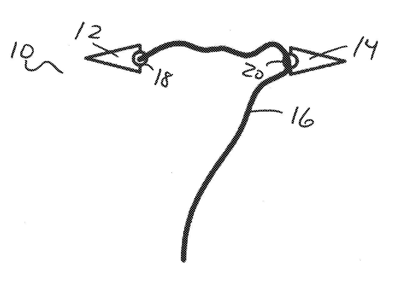 Methods and devices for treating hallux valgus