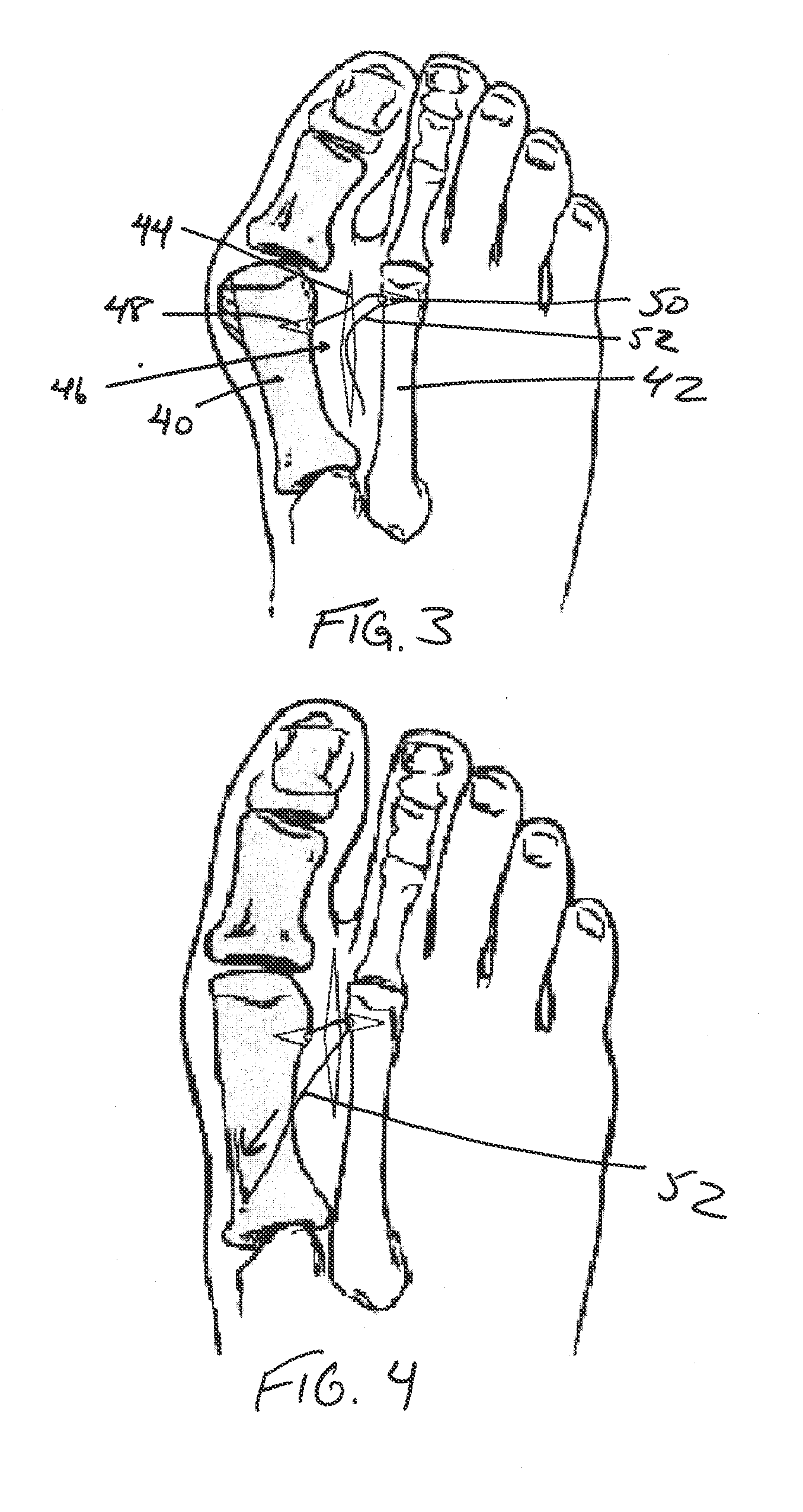 Methods and devices for treating hallux valgus