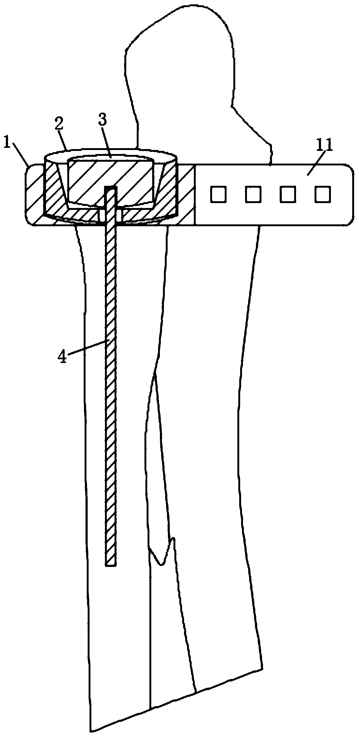 Medical artificial proximal radioulnar joint prosthesis