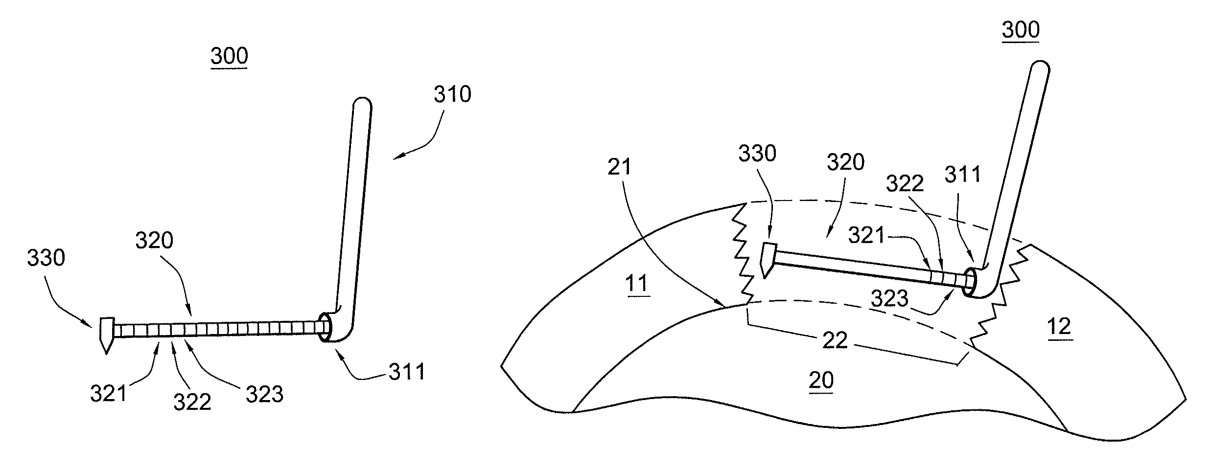 Method and instrumentation for acetabular labrum reconstruction