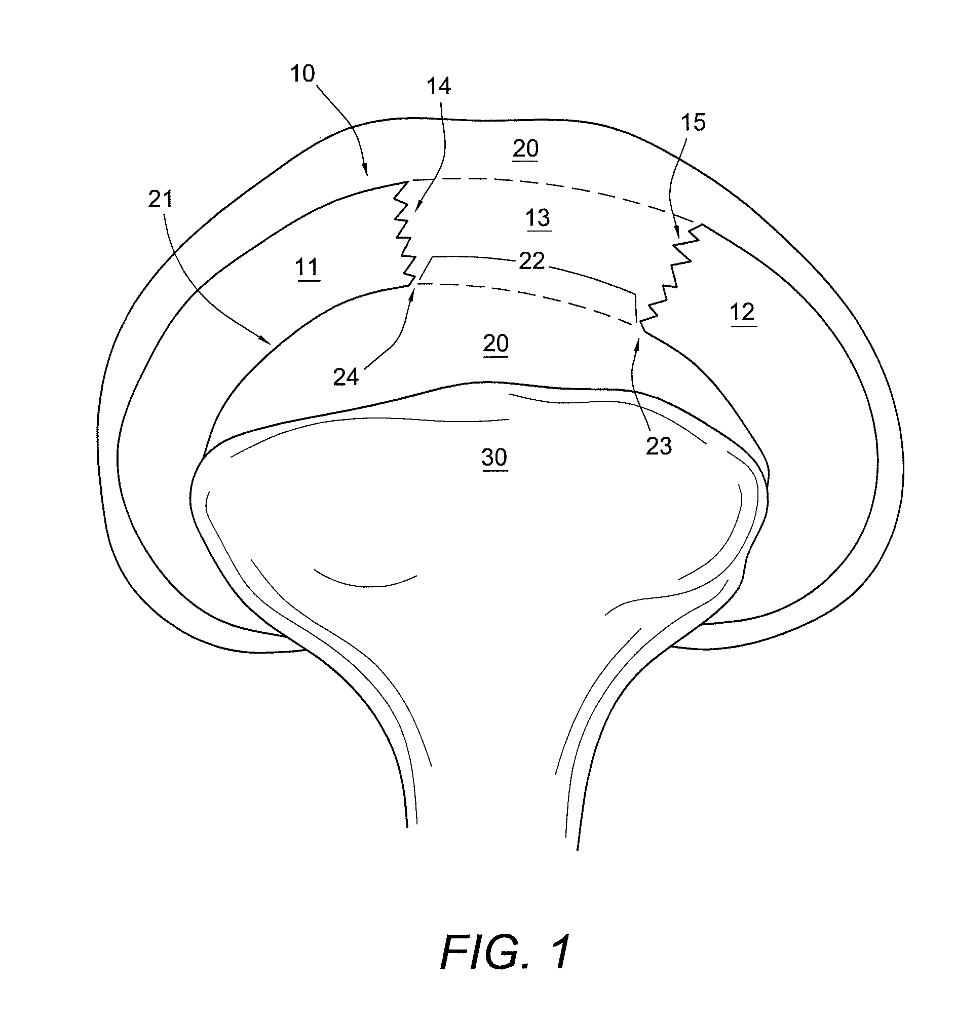 Method and instrumentation for acetabular labrum reconstruction