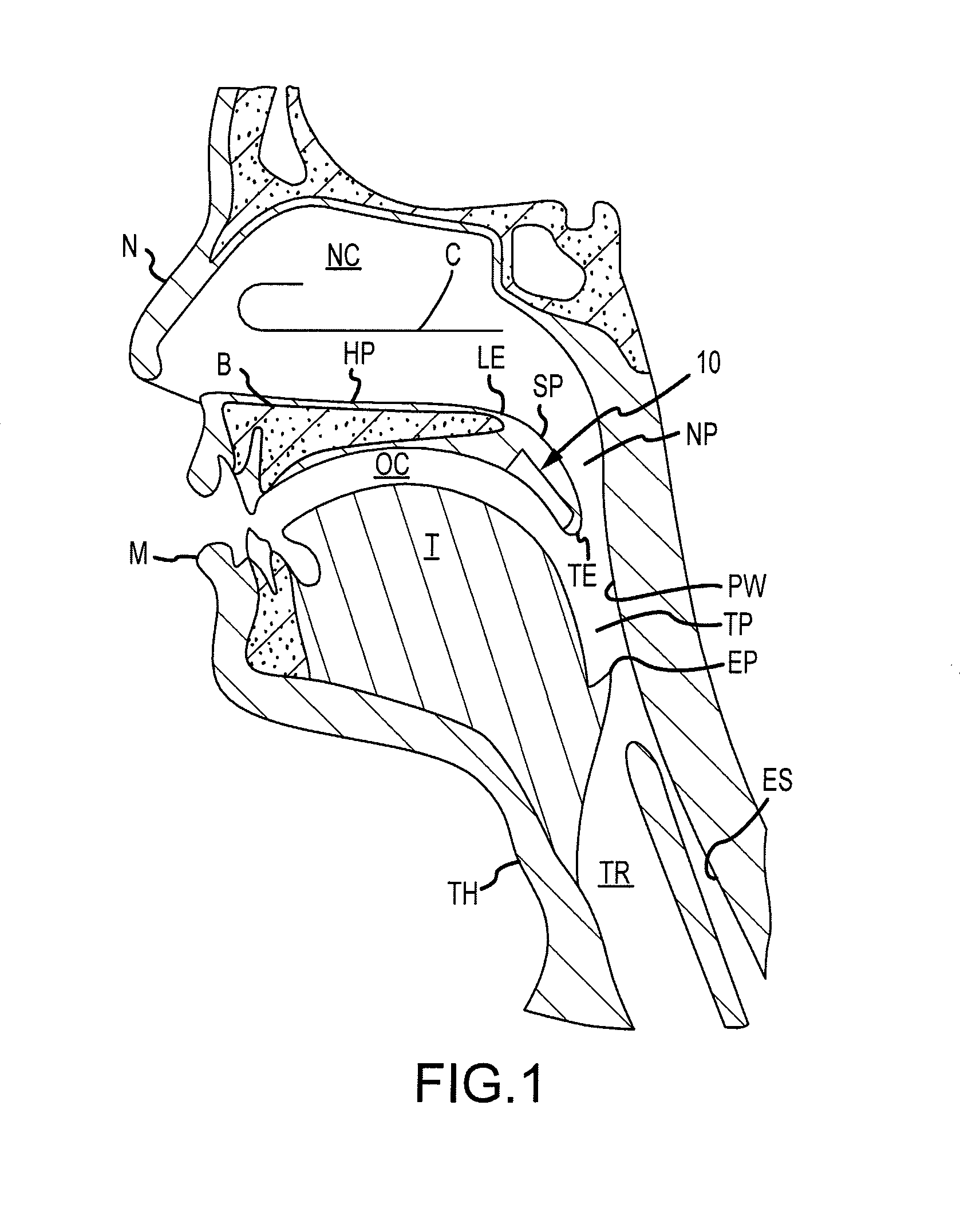 Buccal bioadhesive strip and method of treating snoring and sleep apnea