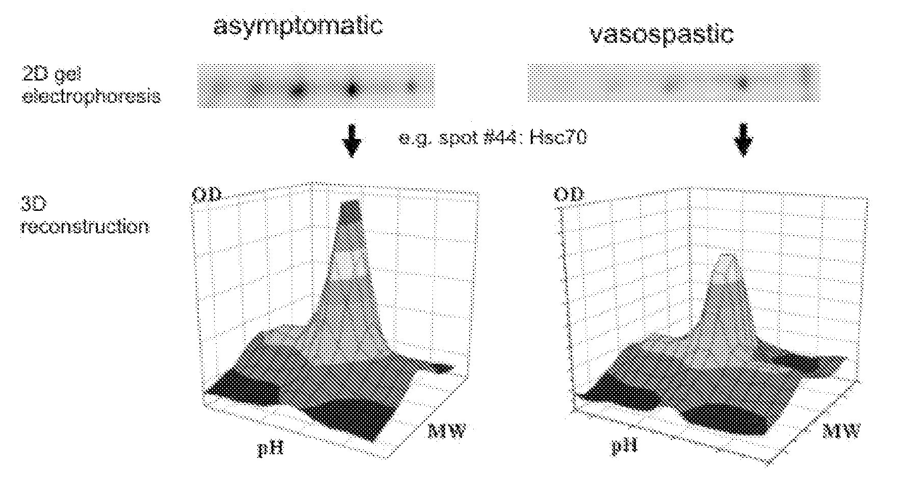 Screening Method for the Early Diagnosis of Cerebral Vasospasm