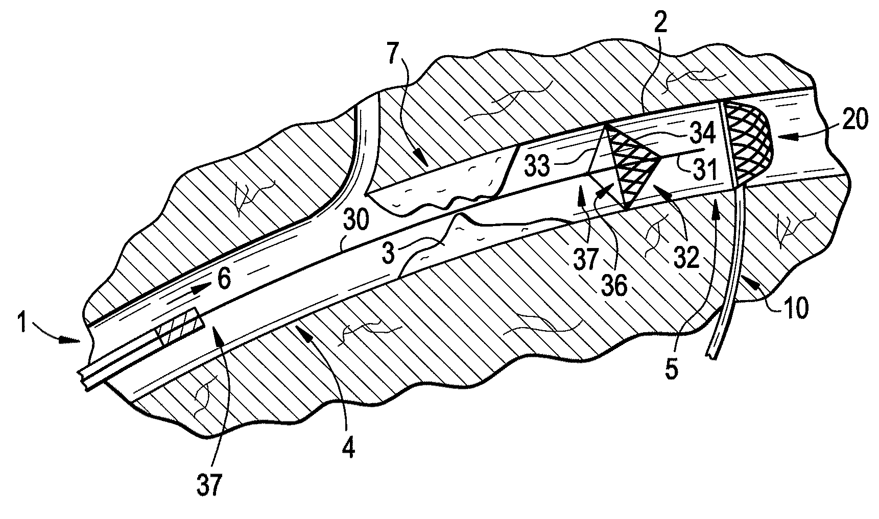 Distal access embolic protection system and methods of using the same