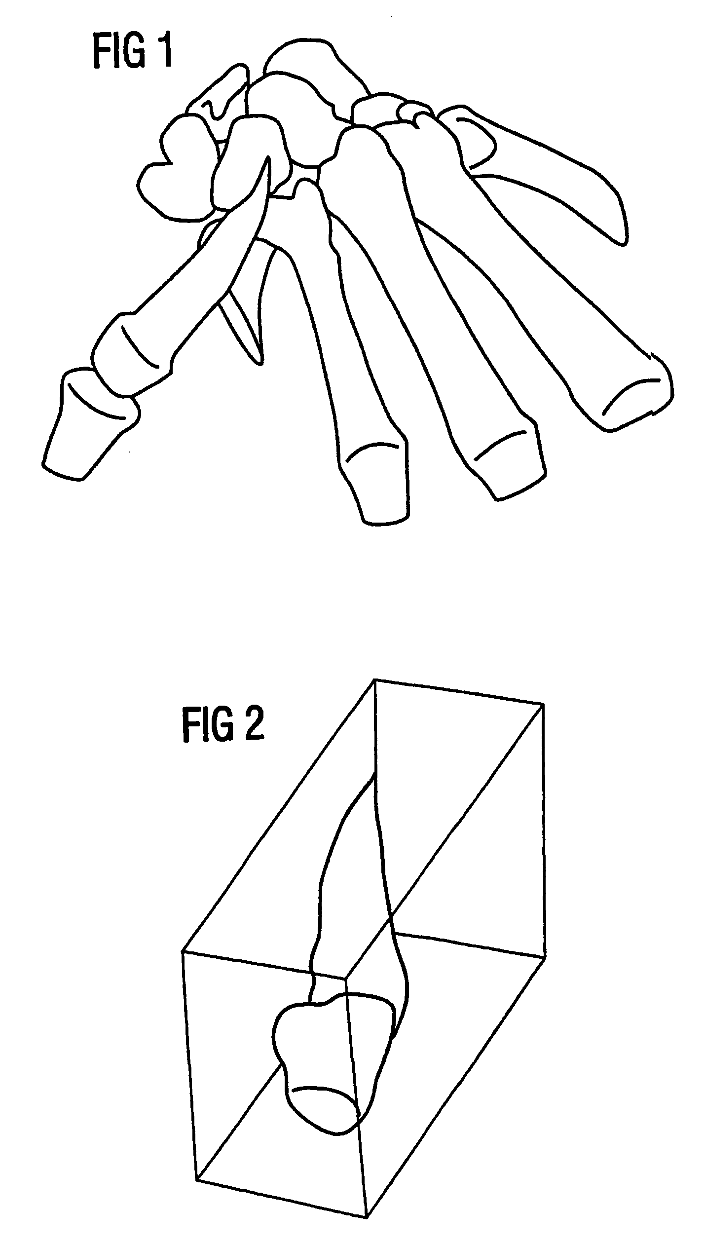 Method, device and software for separating the individual subjects of an anatomical structure segmented from 3D datasets of medical examination procedures