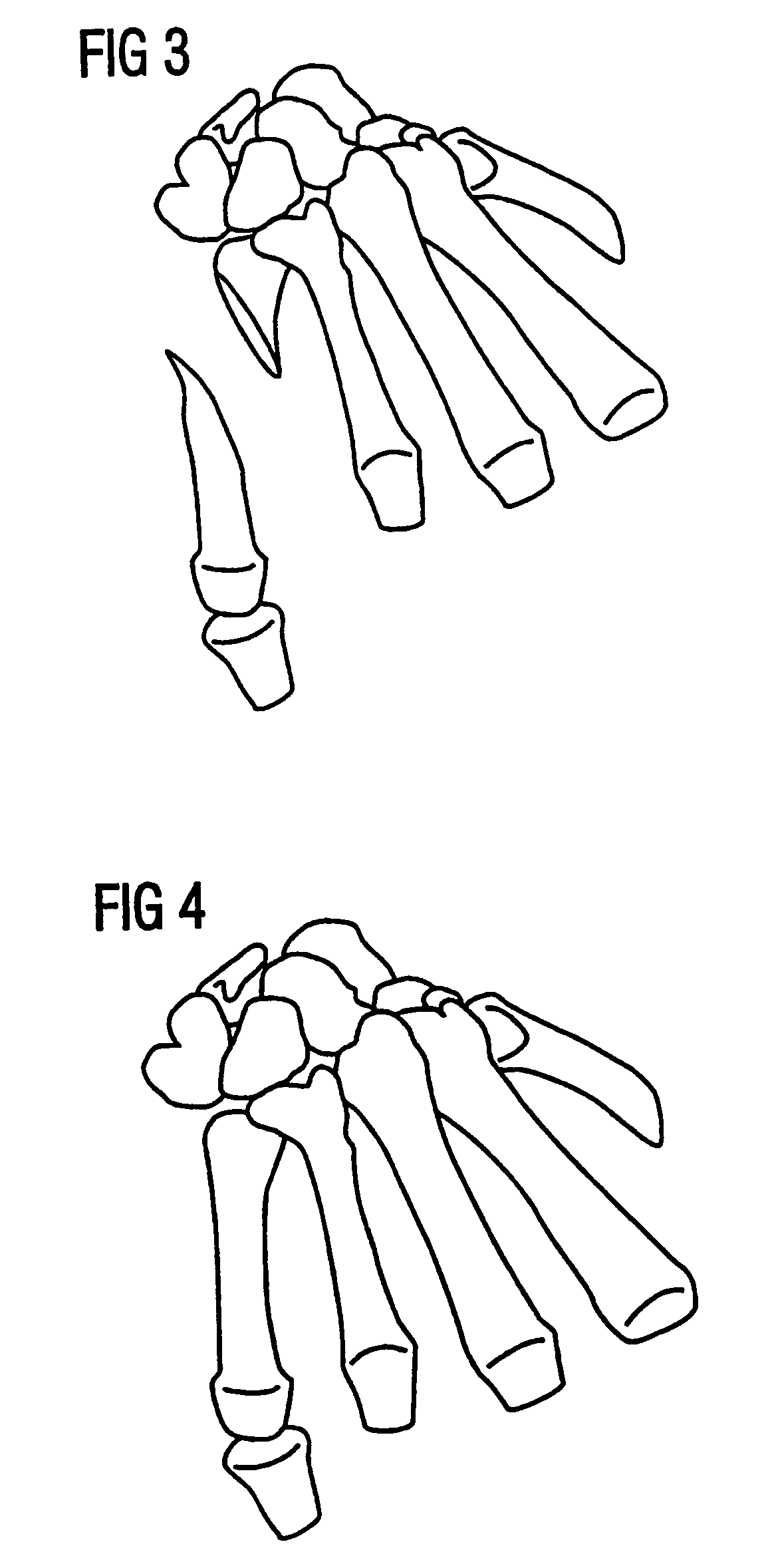 Method, device and software for separating the individual subjects of an anatomical structure segmented from 3D datasets of medical examination procedures