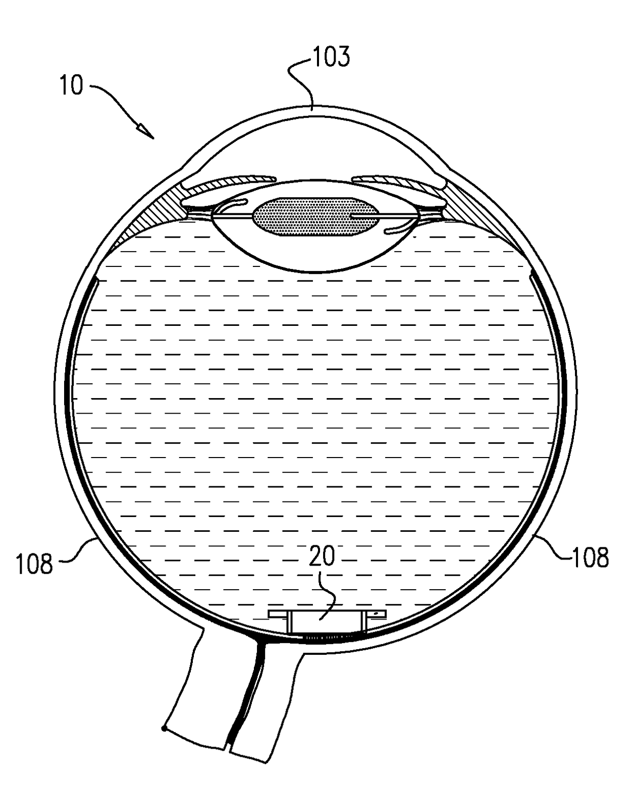 Surgical techniques for implantation of a retinal implant