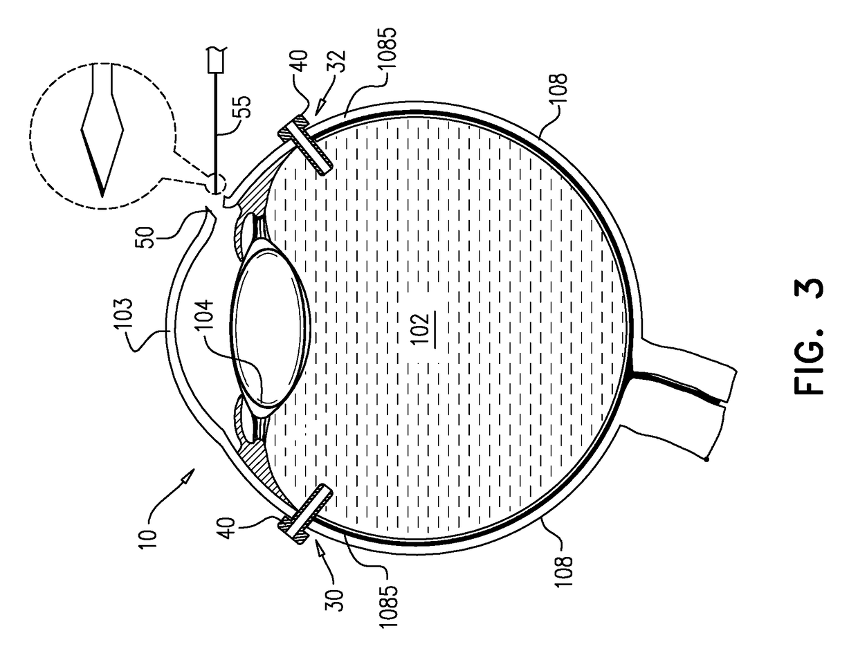 Surgical techniques for implantation of a retinal implant