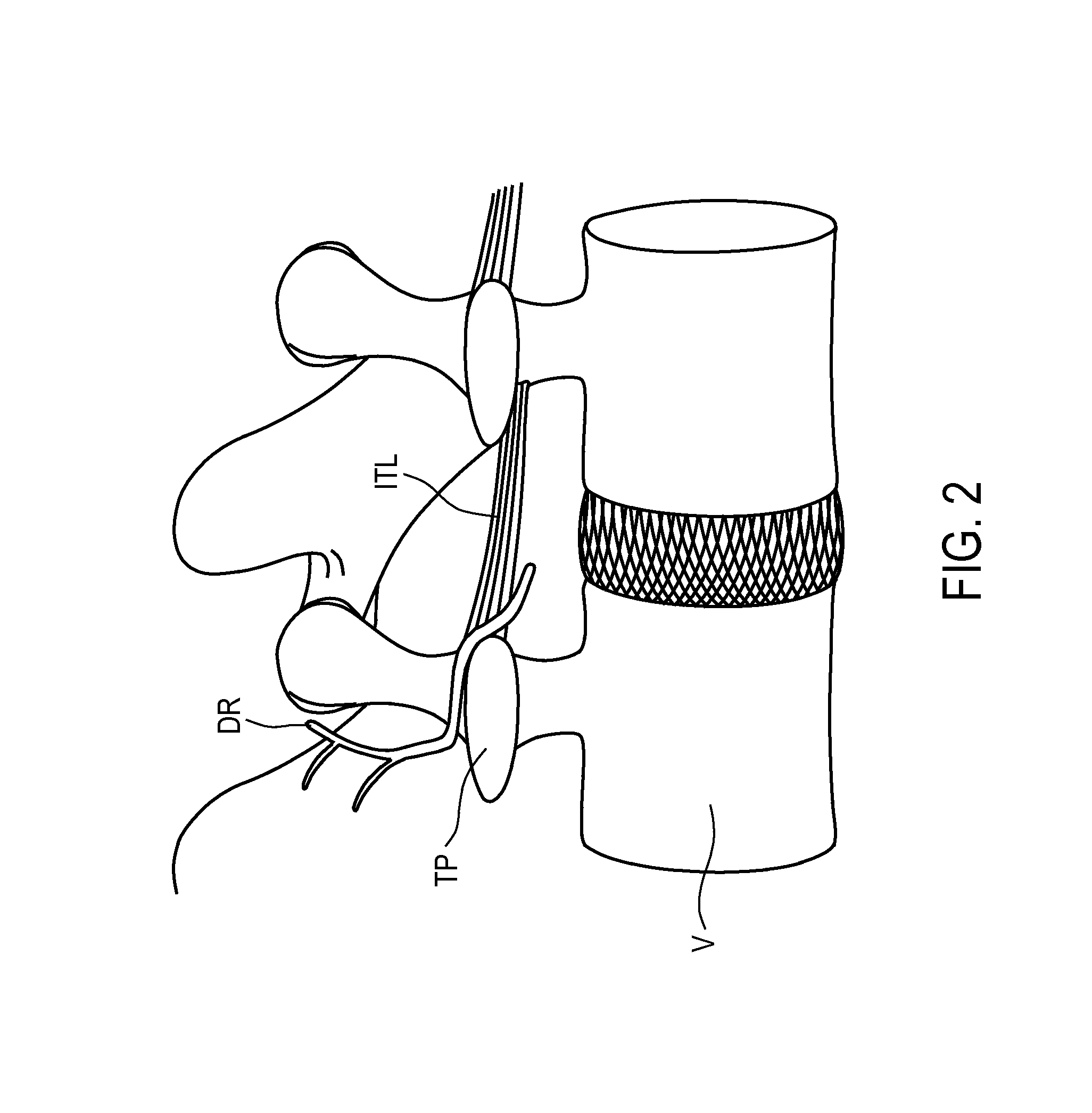 Apparatus and methods for anchoring electrode leads adjacent to nervous tissue