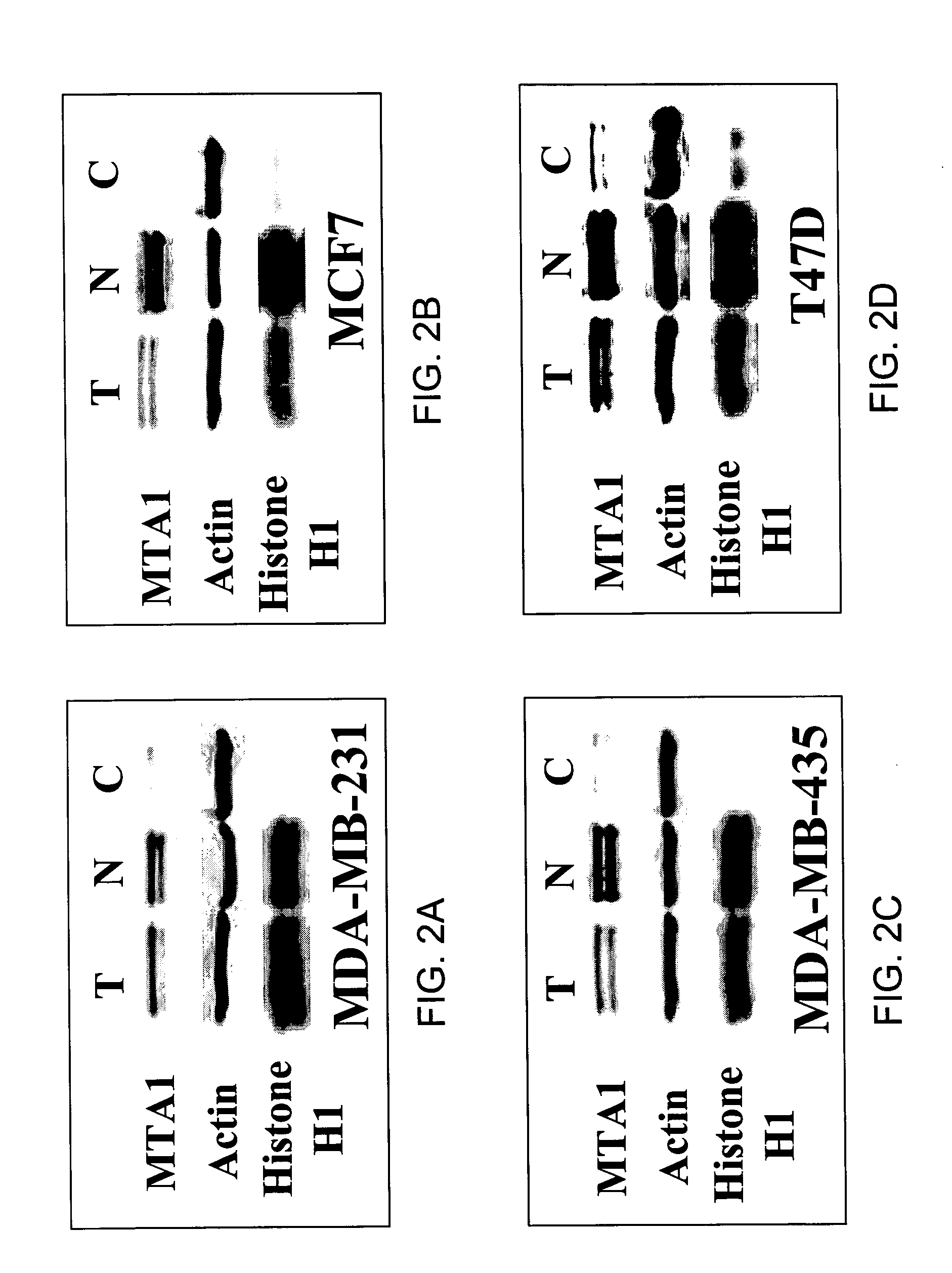 MTA1 is a predictive and prognostic factor in human breast cancer