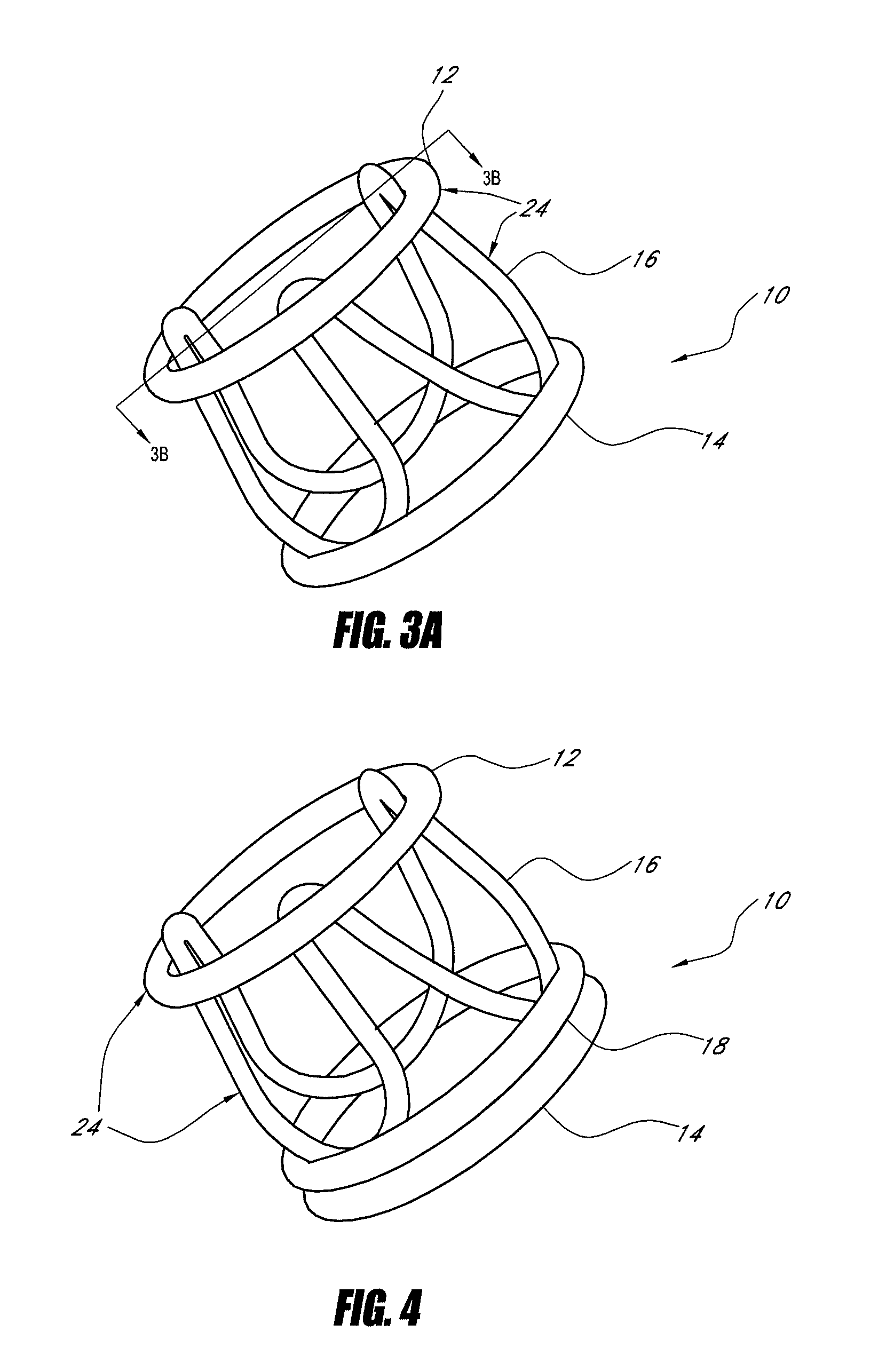 Stentless aortic valve replacement with high radial strength