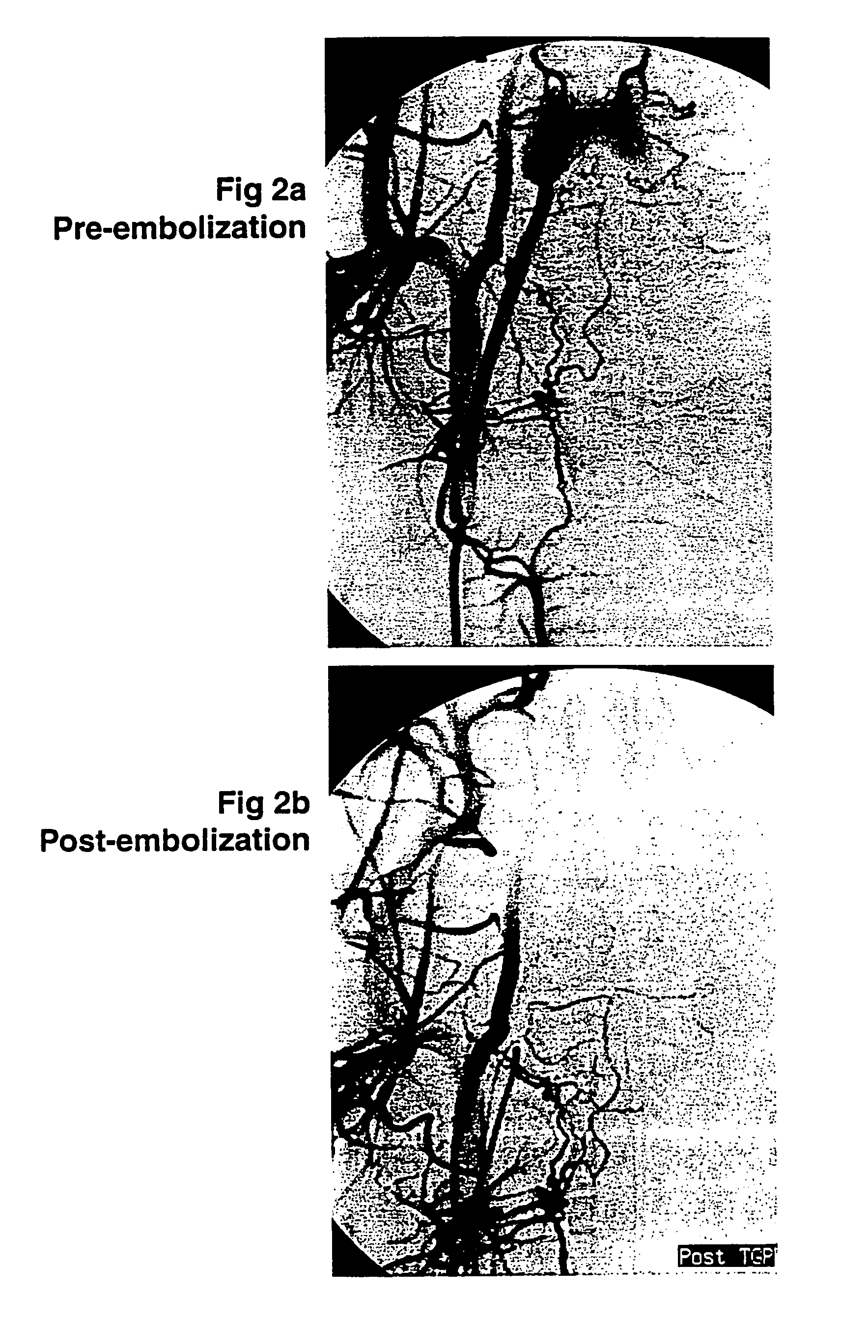 Thermo-reversible polymer for intralumenal implant