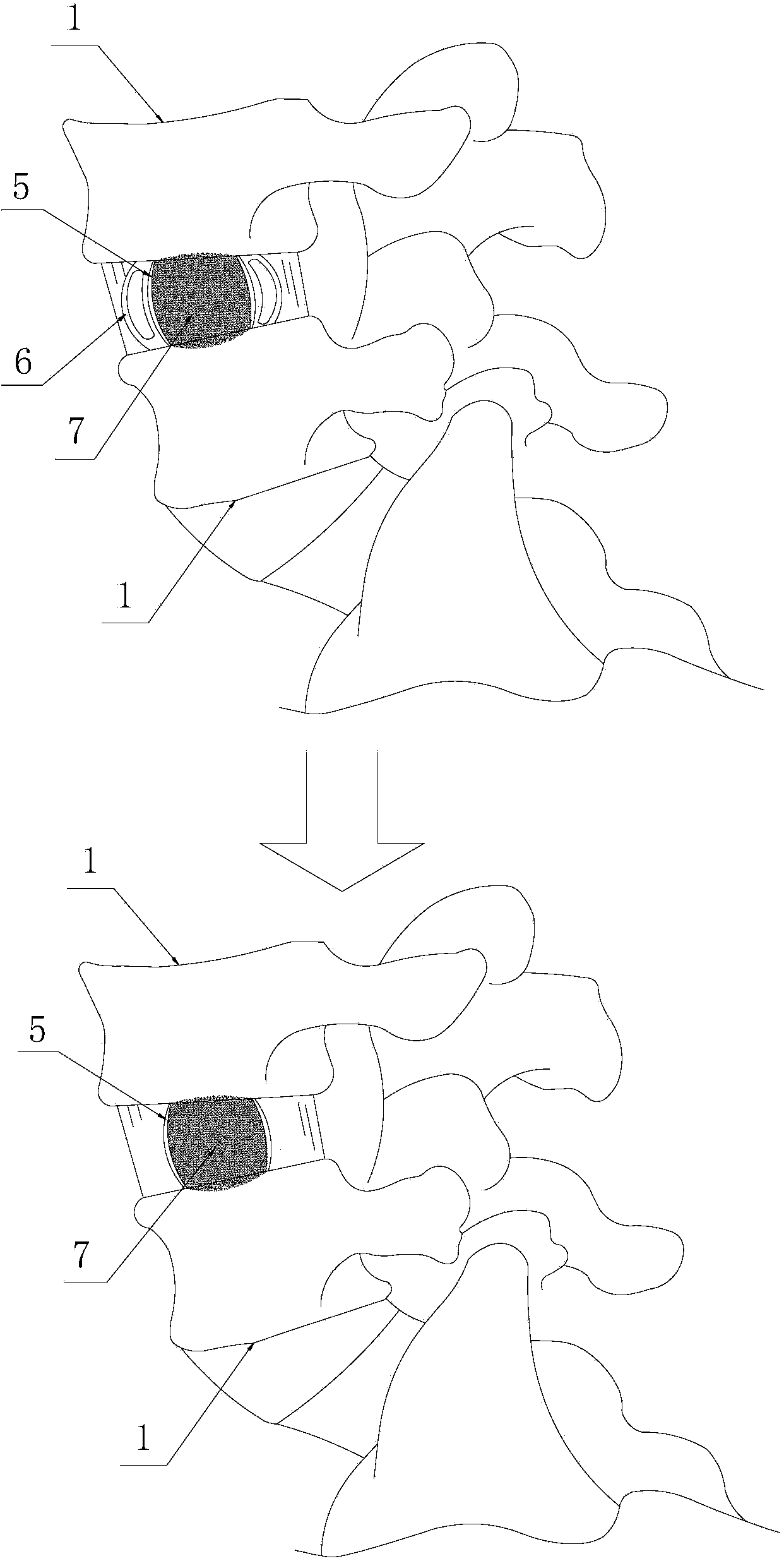 Intervertebral filling fusion device