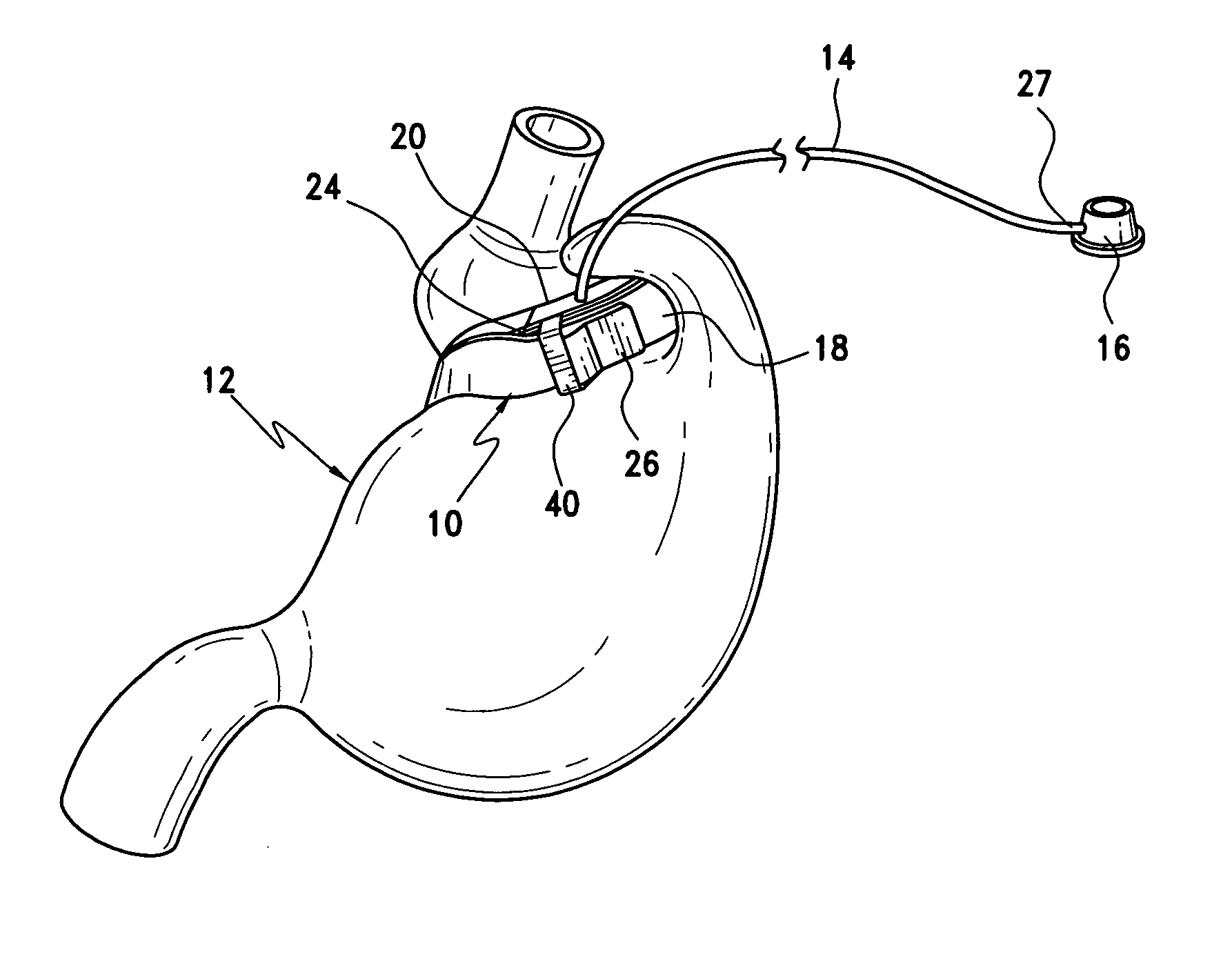 Gastric band with mating end profiles