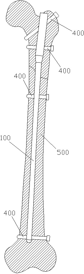 A set of reinforced anti-torsion interlocking intramedullary nails