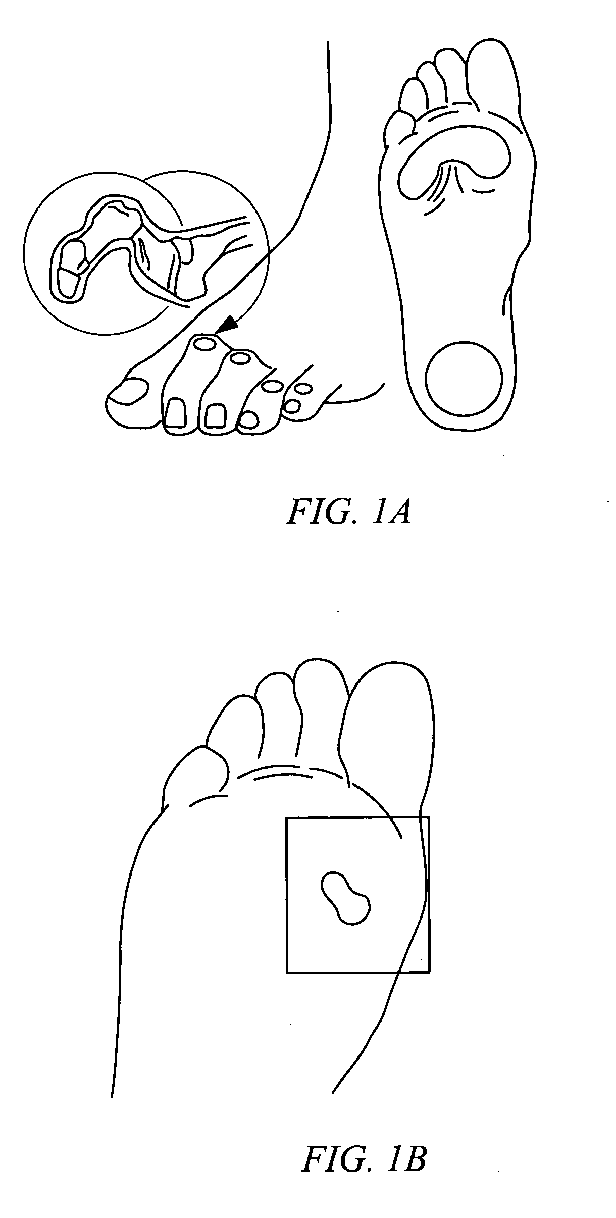 Electrosurgical method and system for treating foot ulcer