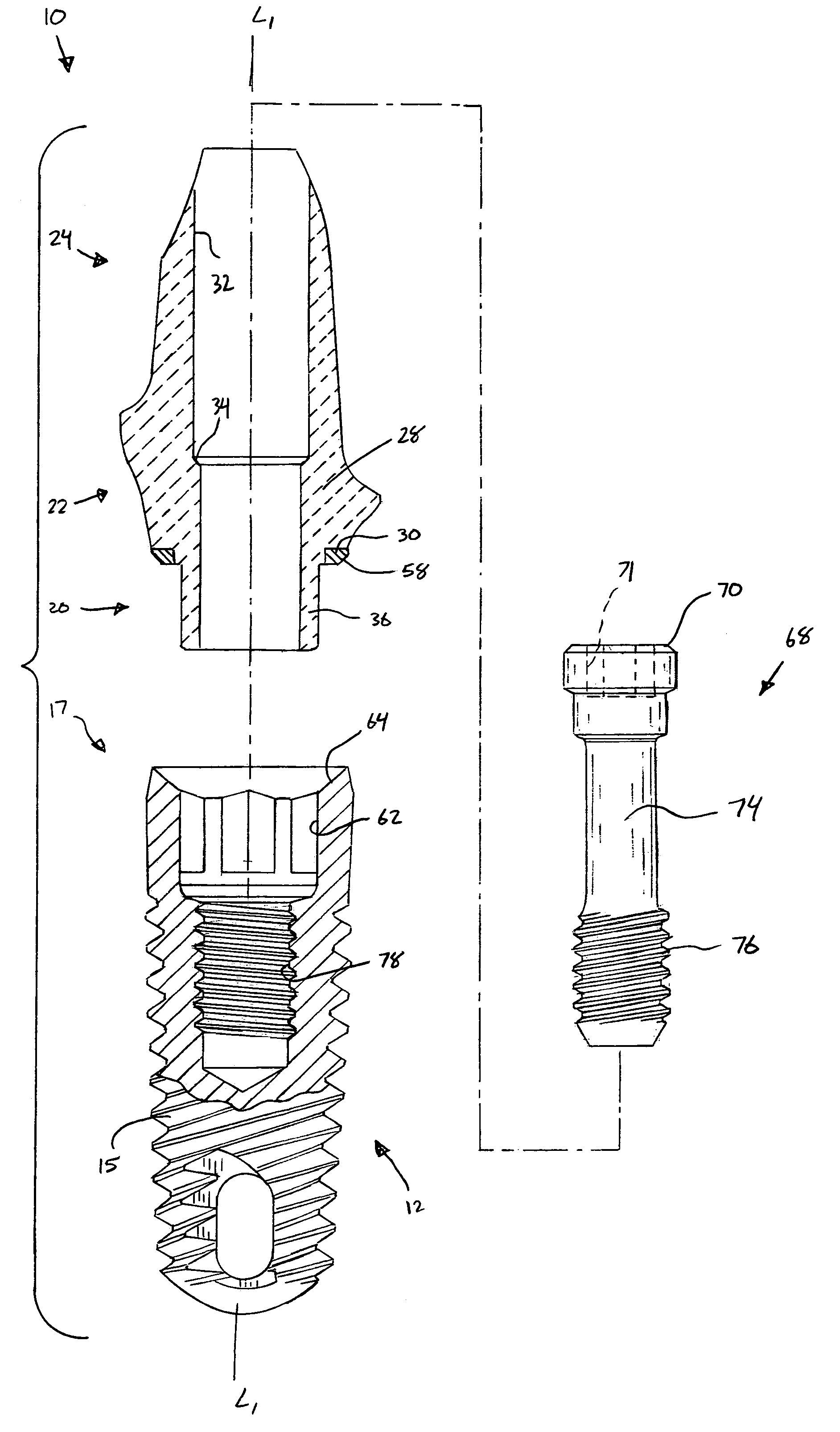 Ceramic/metallic dental abutment