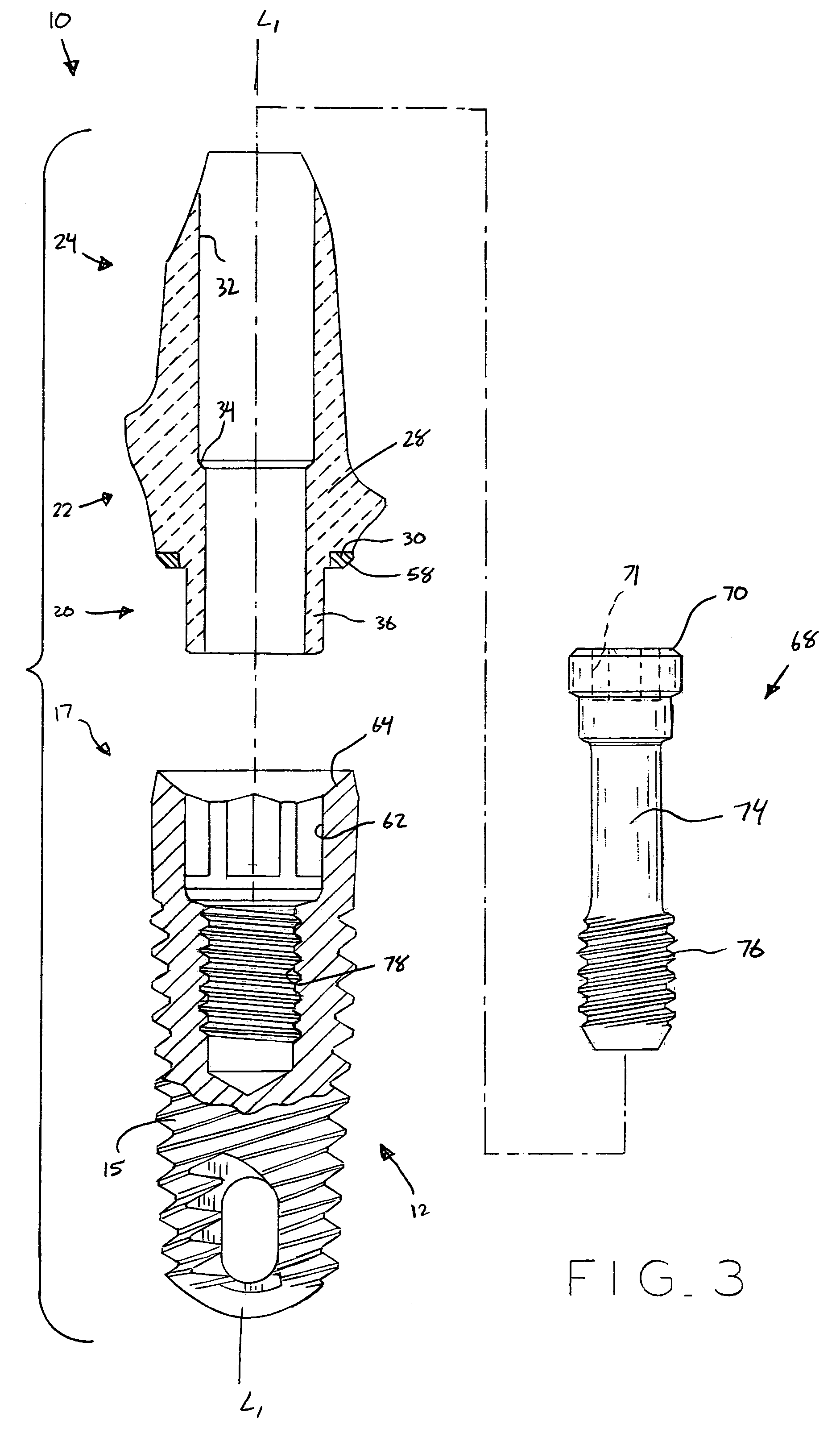 Ceramic/metallic dental abutment