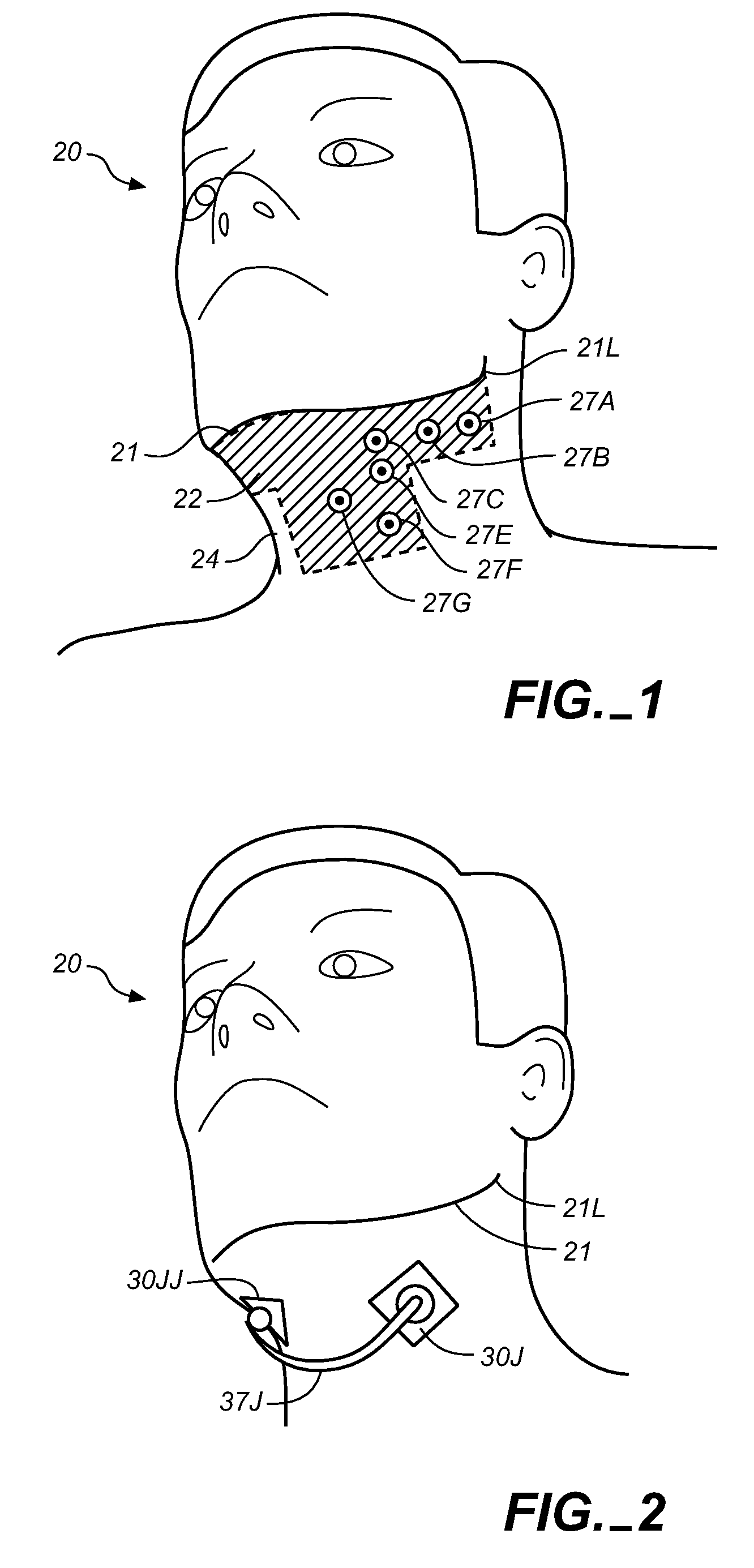 Method and apparatus for treatment of snoring and sleep apnea