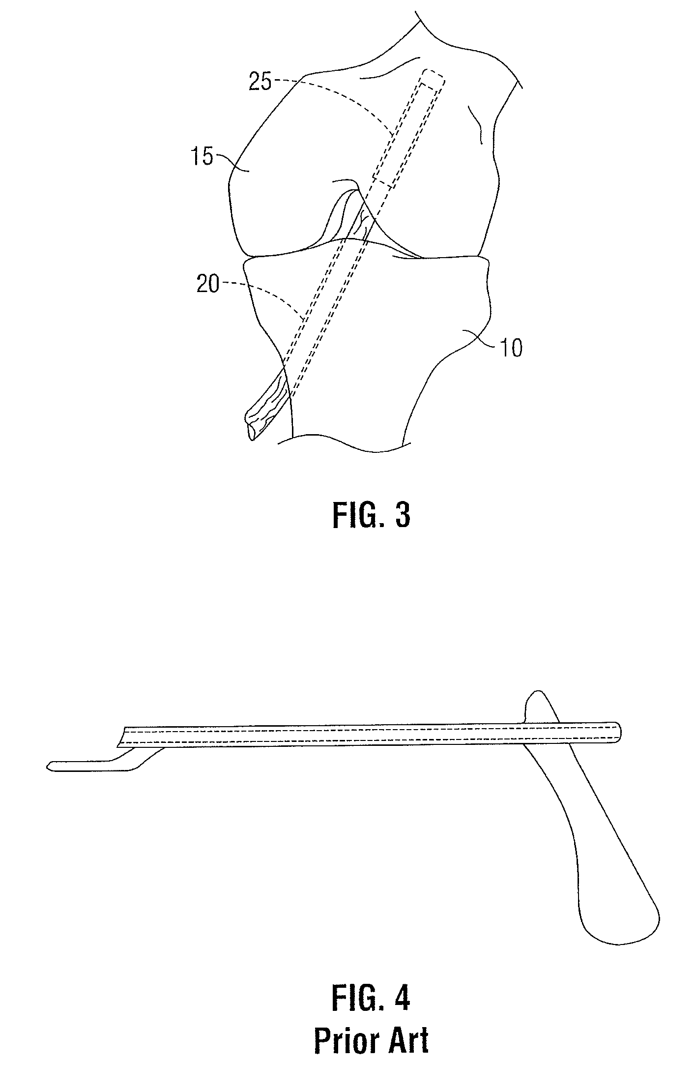 Femoral guide for ACL repair having adjustable offset