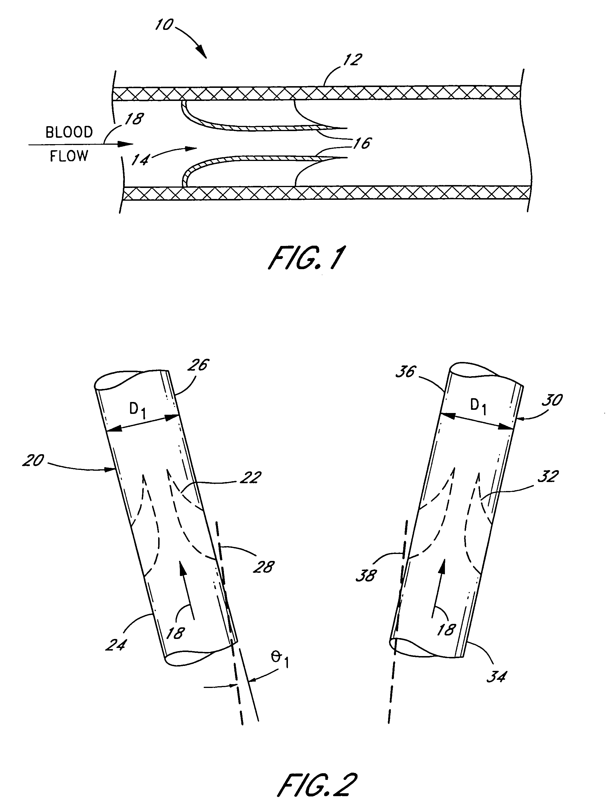 Bifurcated biological pulmonary valved conduit