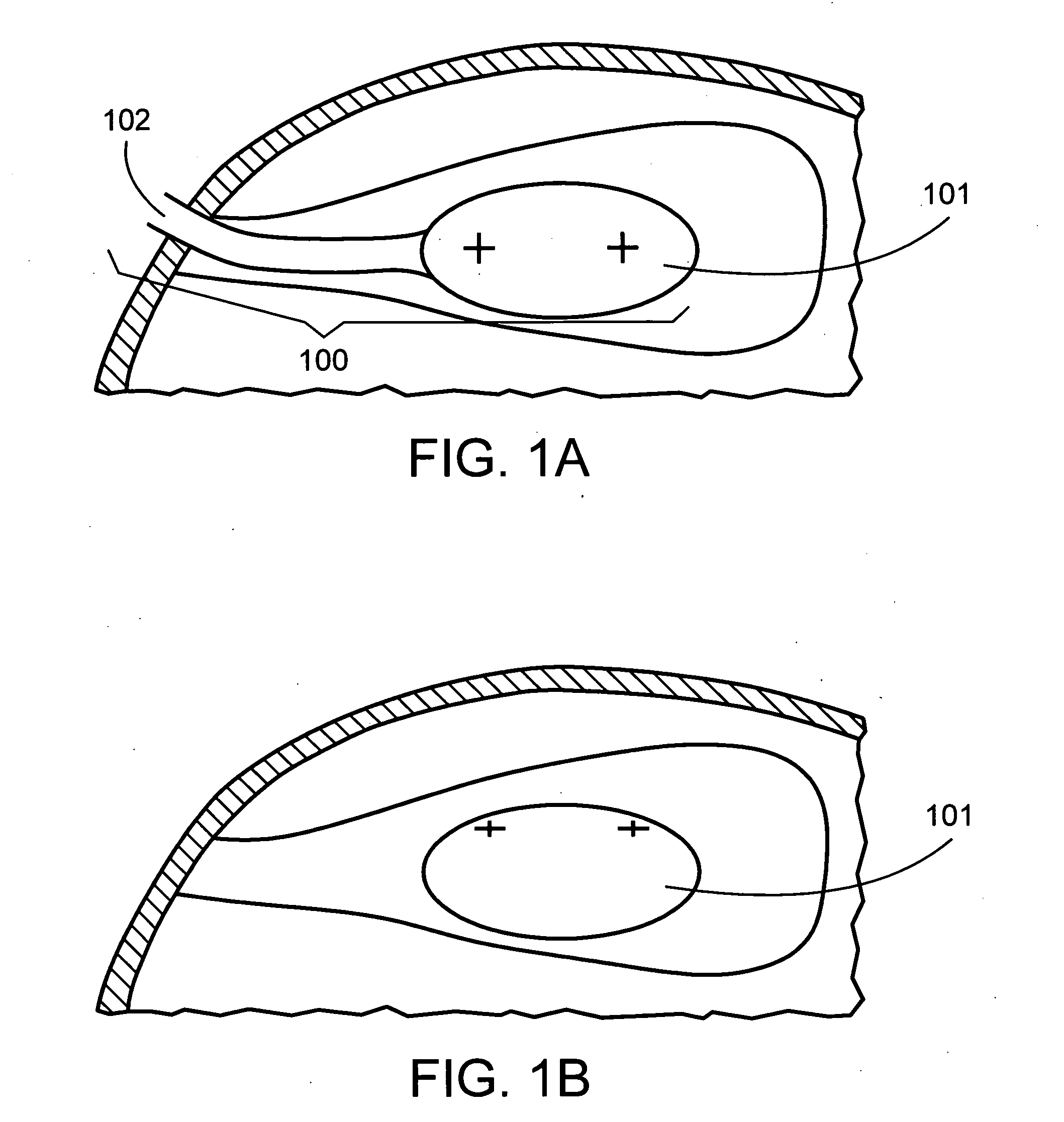 Brachytherapy apparatus and methods employing expandable medical devices comprising fixation elements