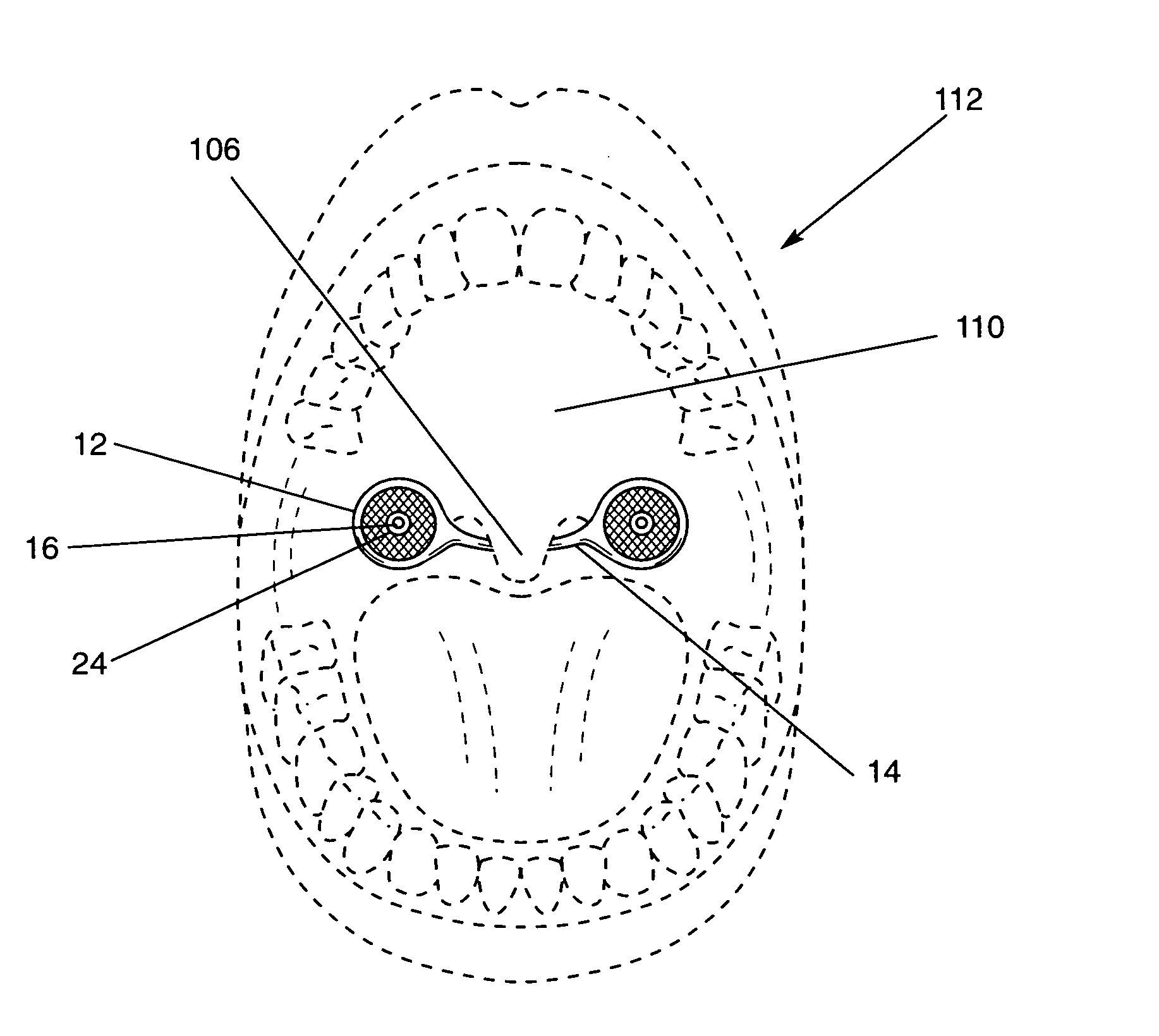 Anti-snoring apparatus and method