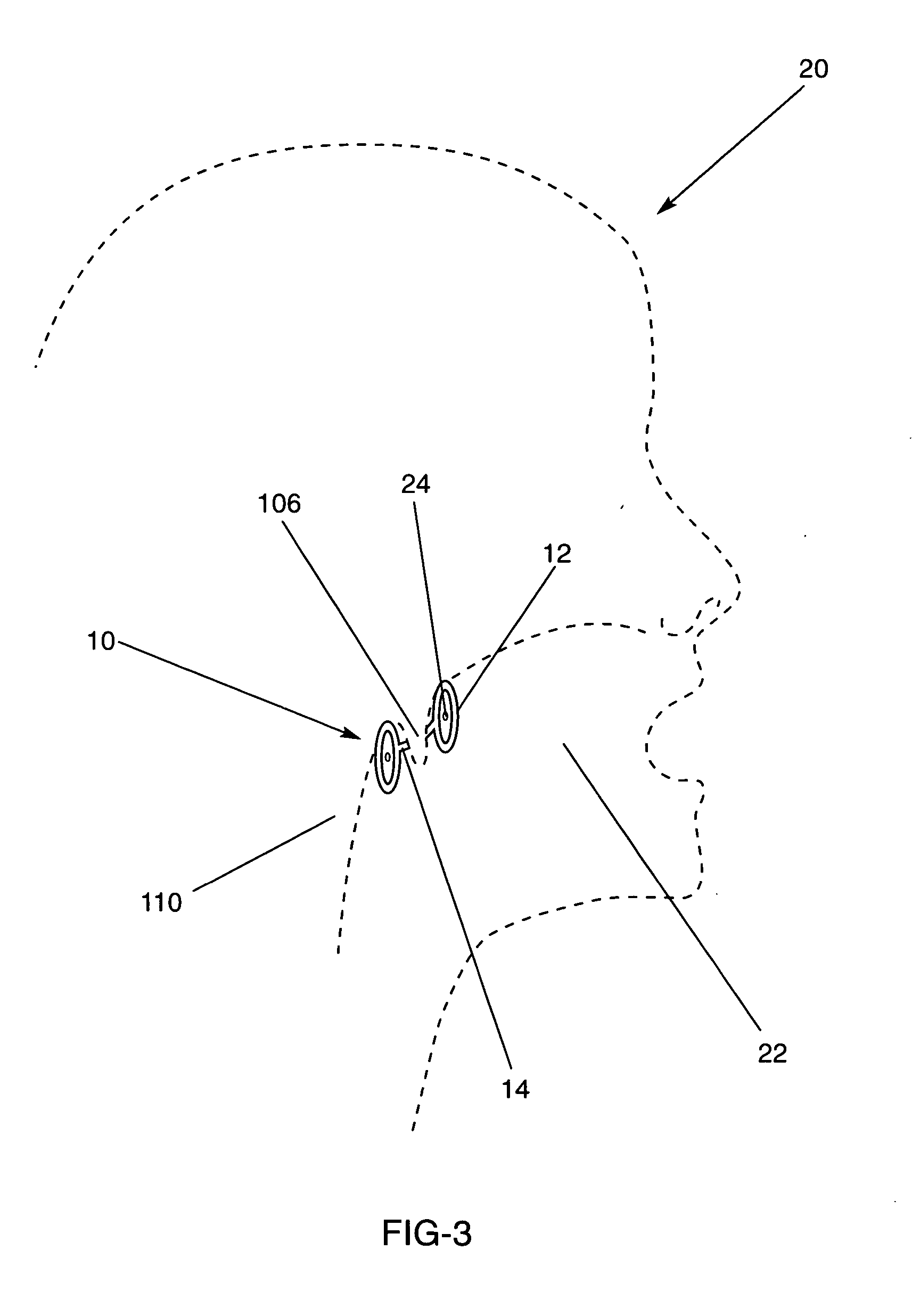 Anti-snoring apparatus and method