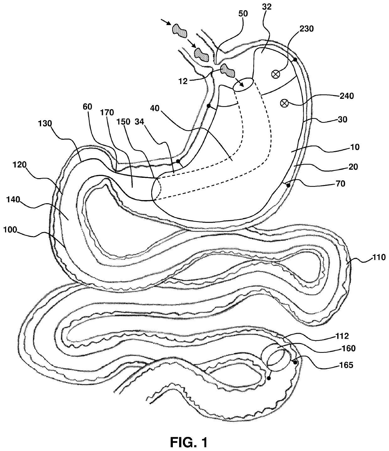 Sleeve-anchorable gastric balloon for weight loss