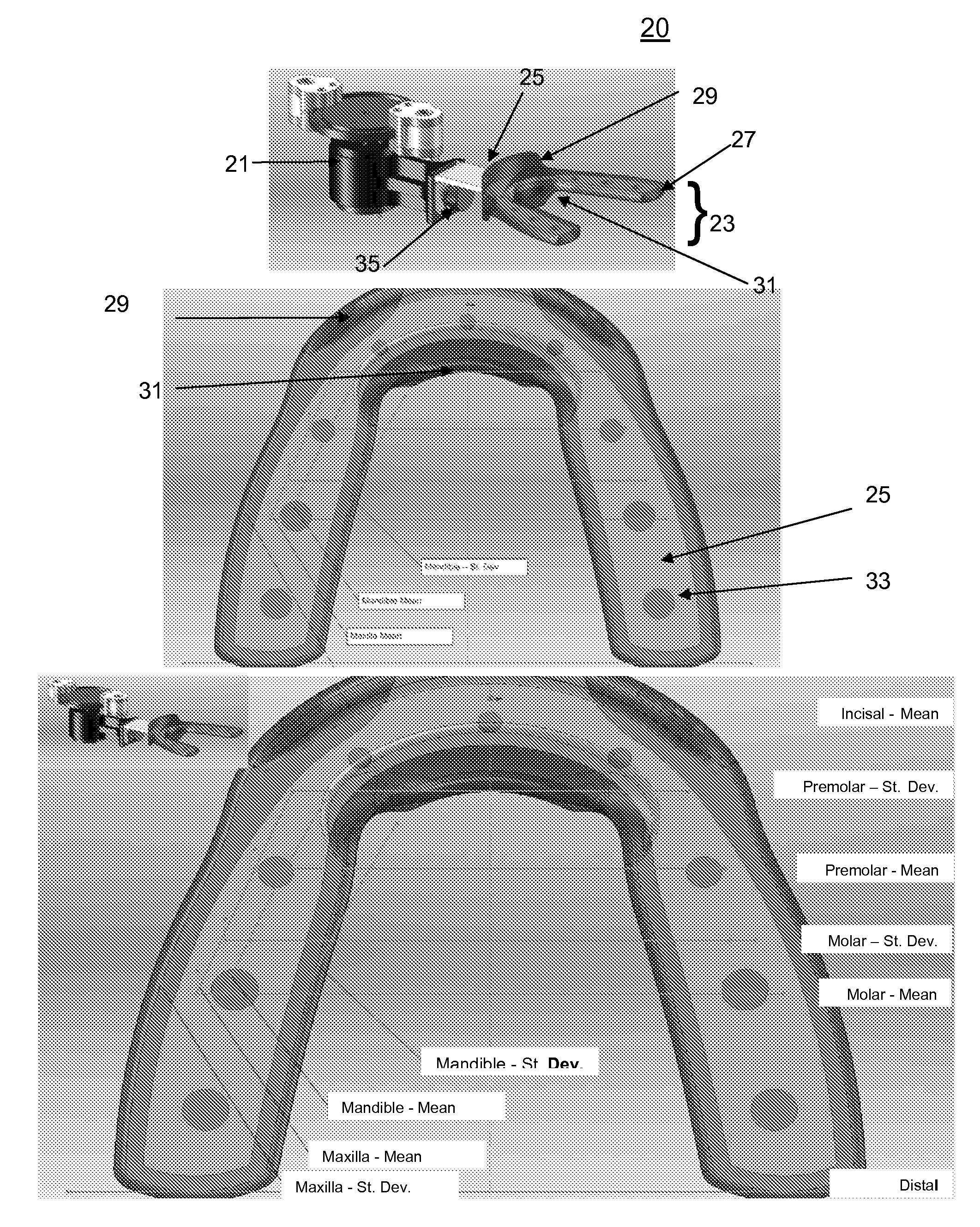 Vibrating compressible dental plate for correcting malocclusion