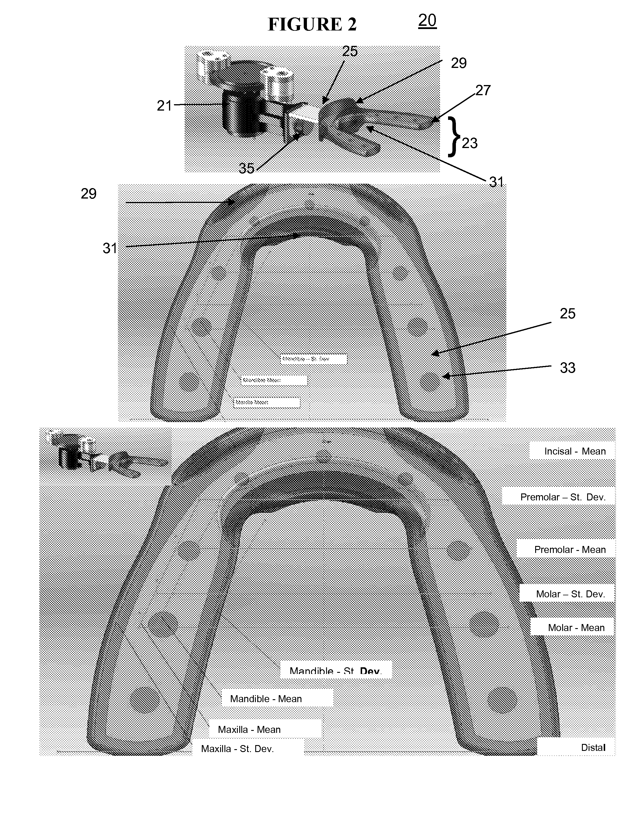 Vibrating compressible dental plate for correcting malocclusion