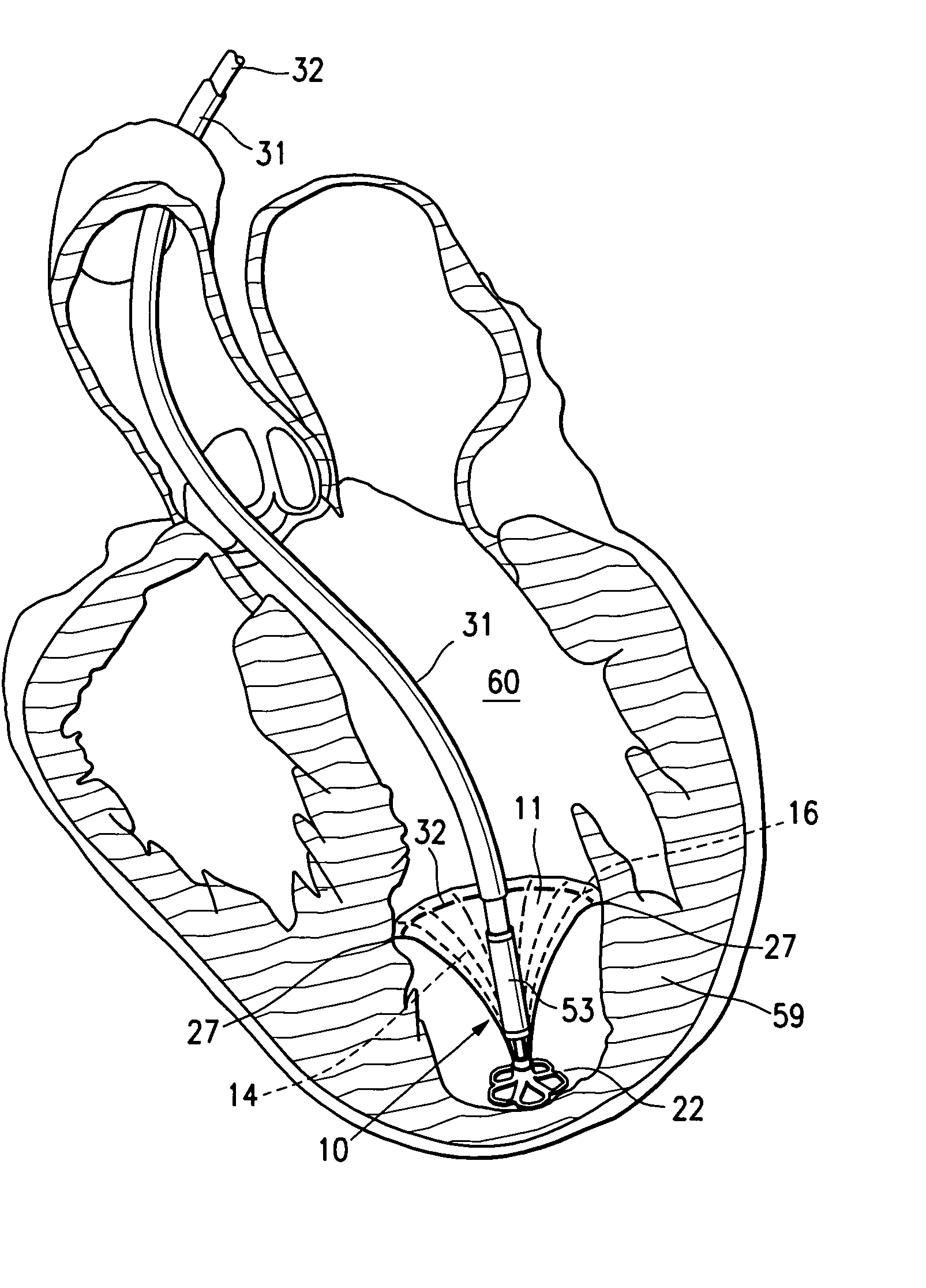 Peripheral seal for a ventricular partitioning device