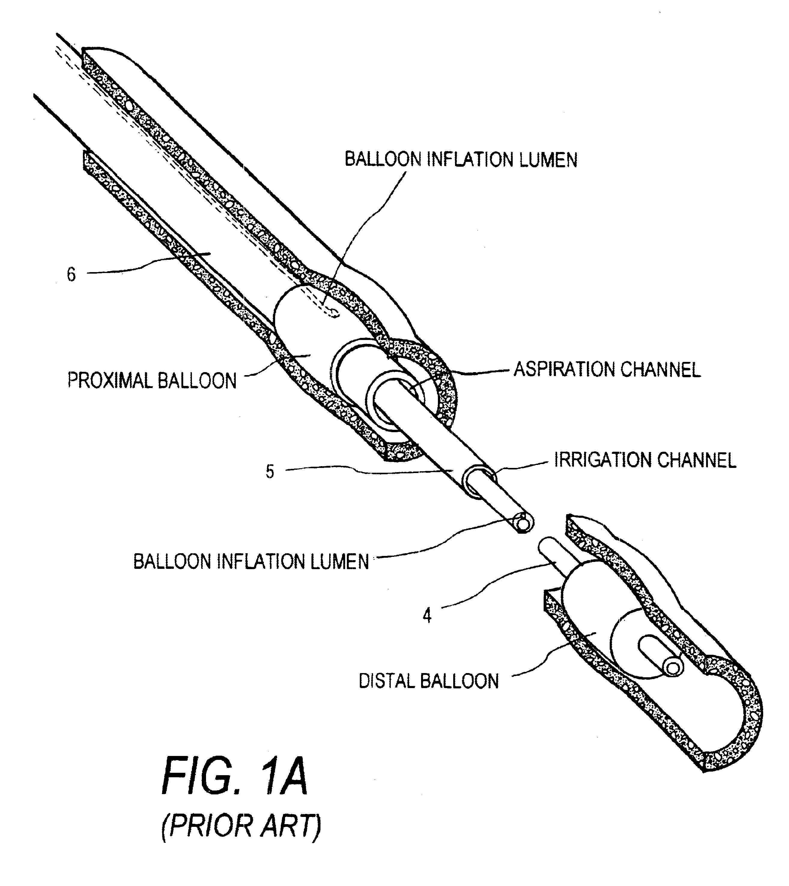 Electrical discharge catheter system for extracting emboli in endovascular interventions