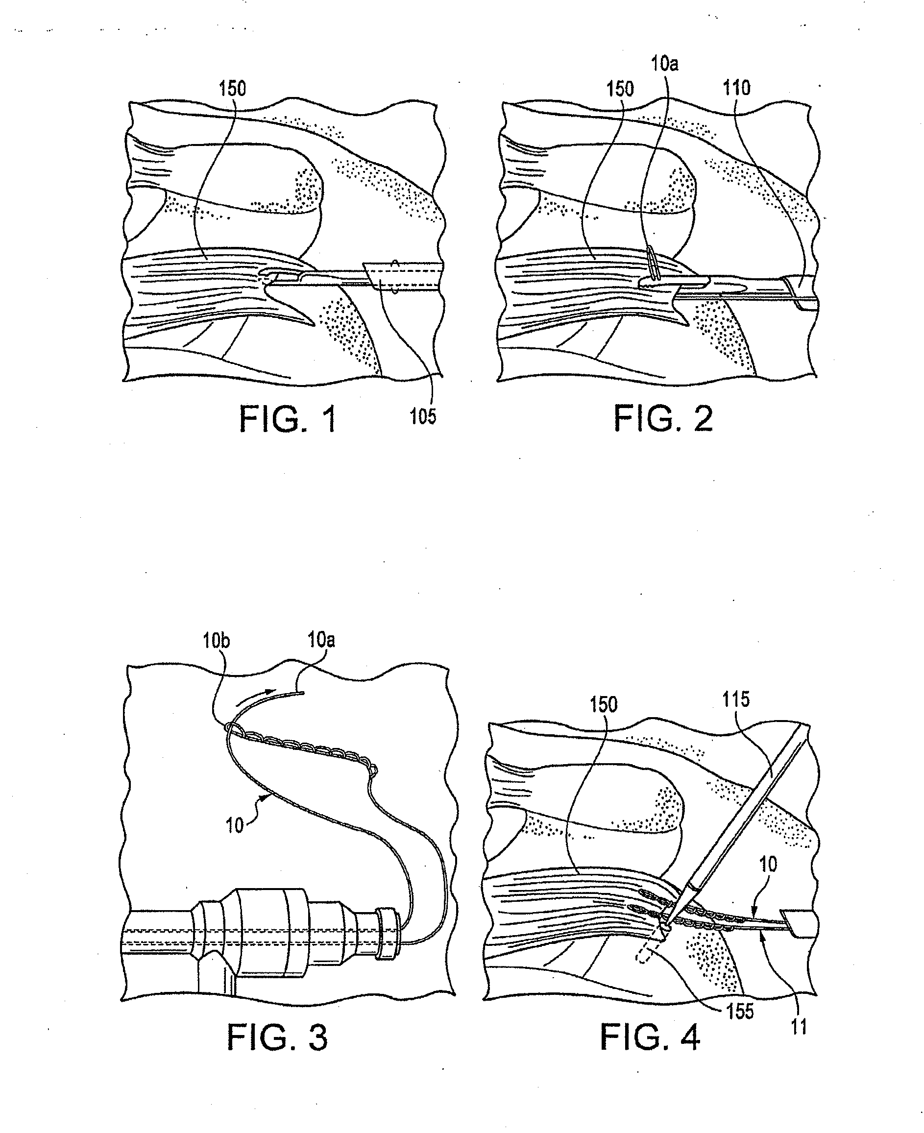 Fenestrated suture anchor and method for knotless fixation of tissue