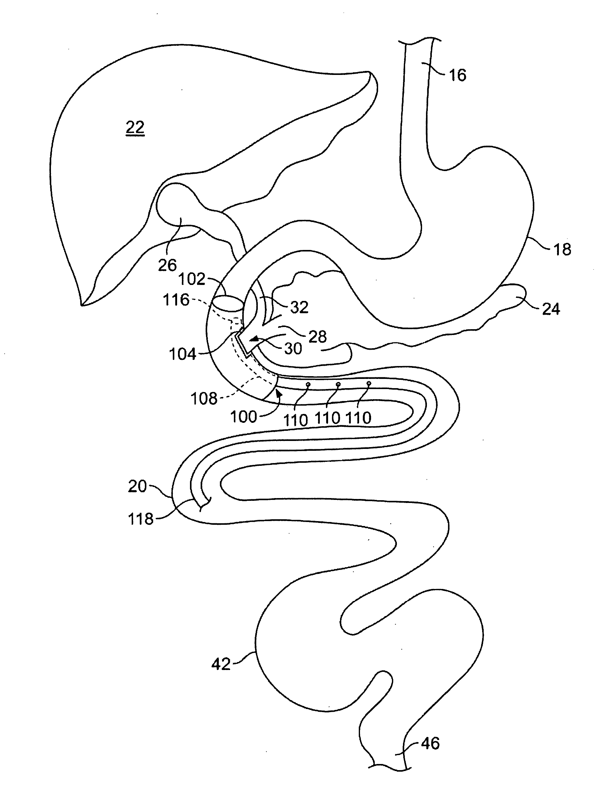 Gastrointestinal implant and methods for use