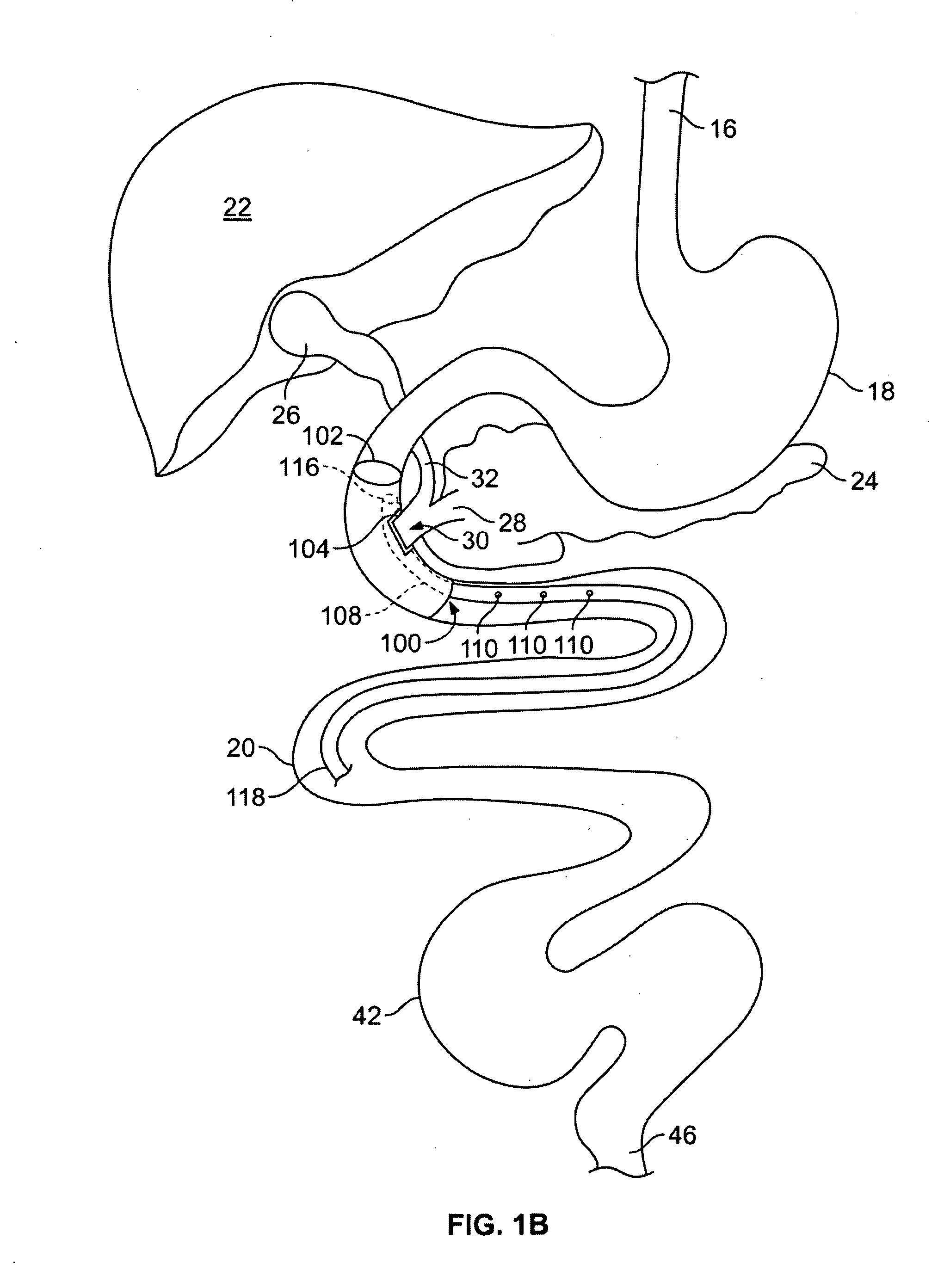 Gastrointestinal implant and methods for use