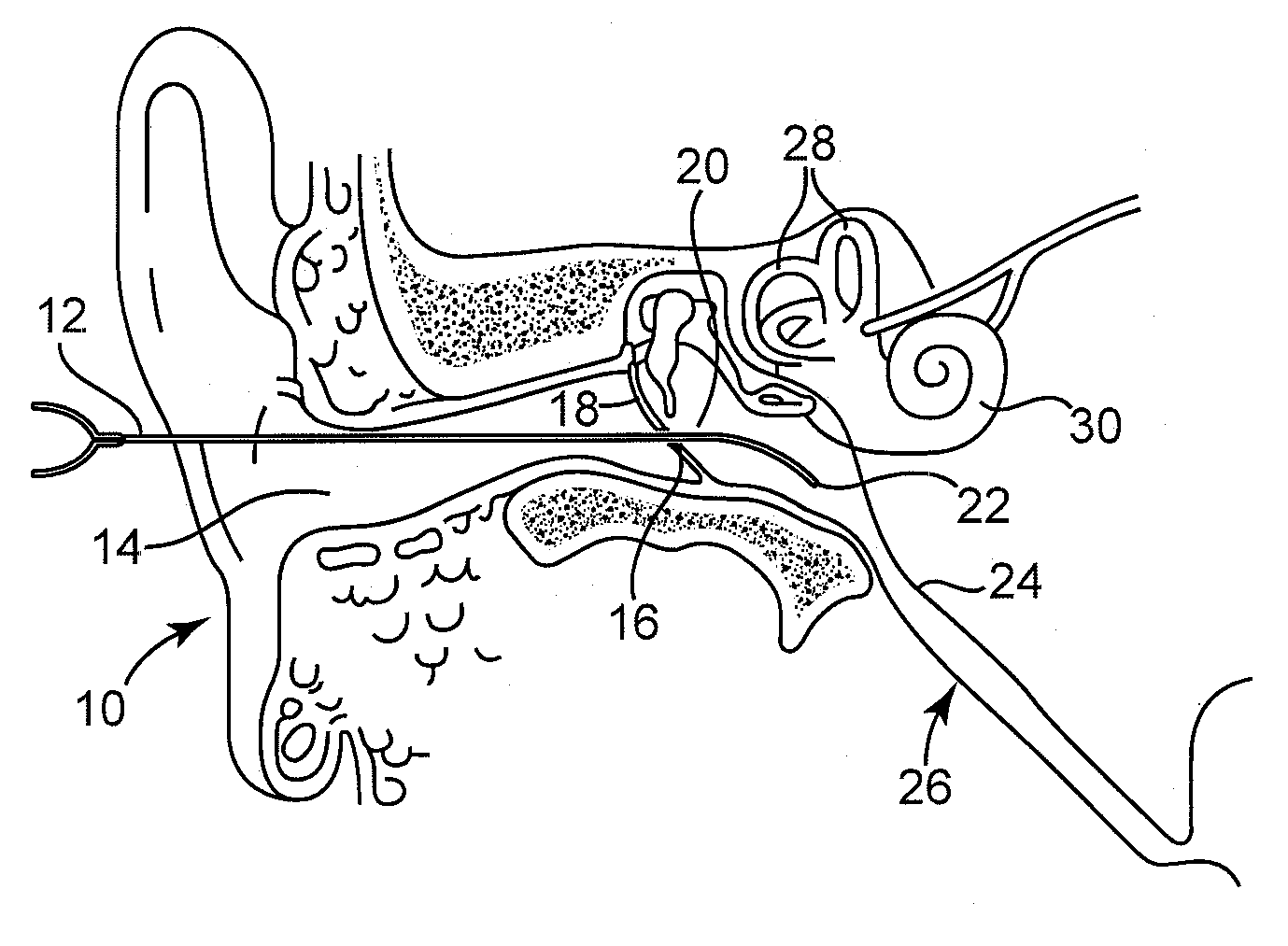 Extracellular polysaccharide solvating system for treatment of bacterial ear conditions