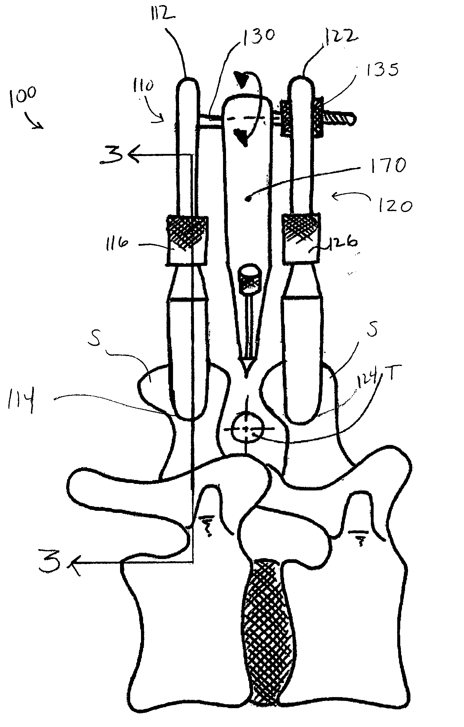 Apparatus and method for treatment of spinal conditions