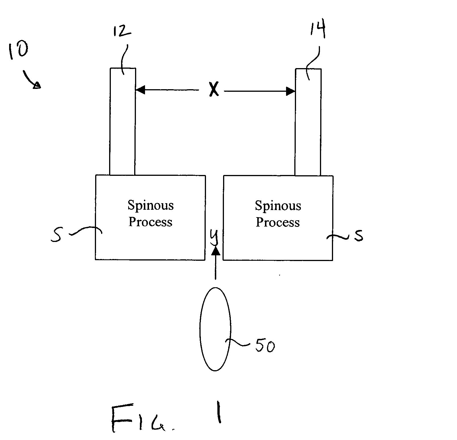 Apparatus and method for treatment of spinal conditions