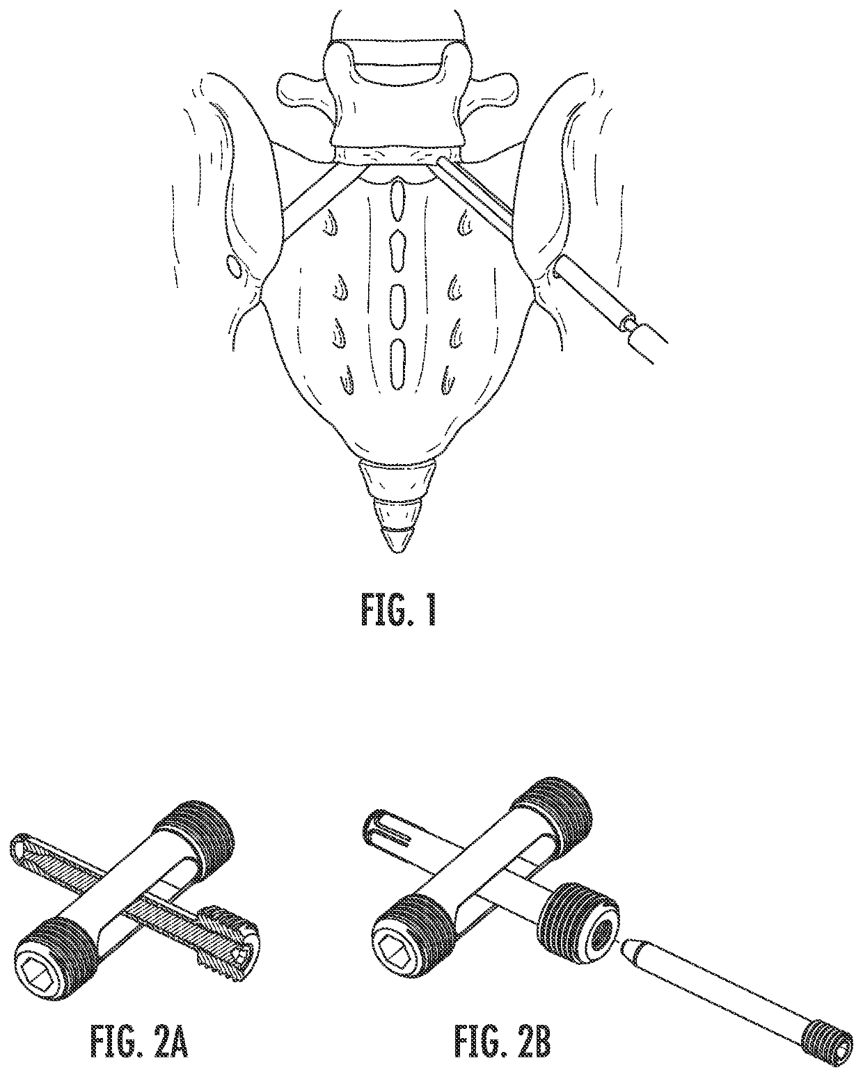 Method for performing spinal surgical procedures through the sacral ala