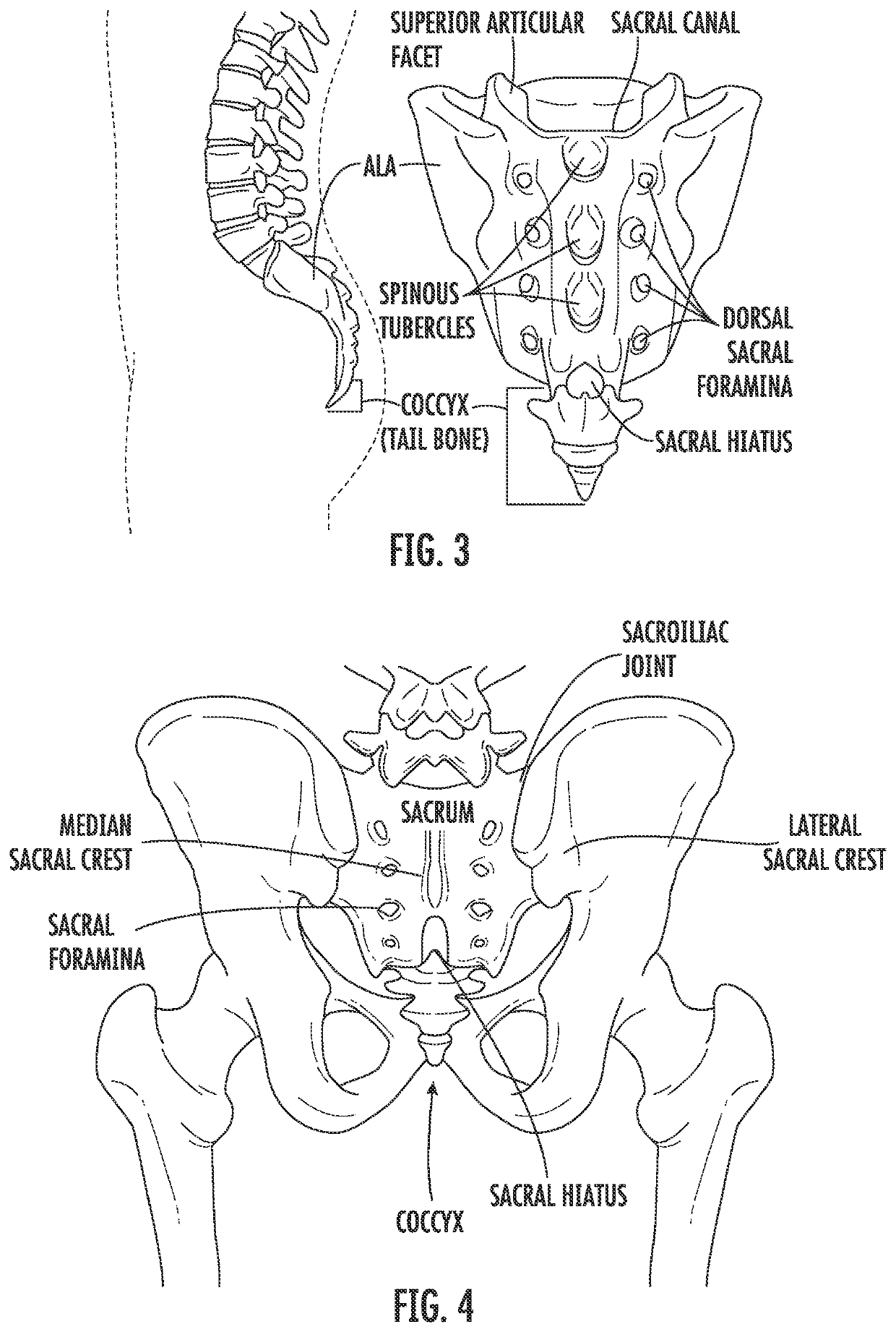 Method for performing spinal surgical procedures through the sacral ala