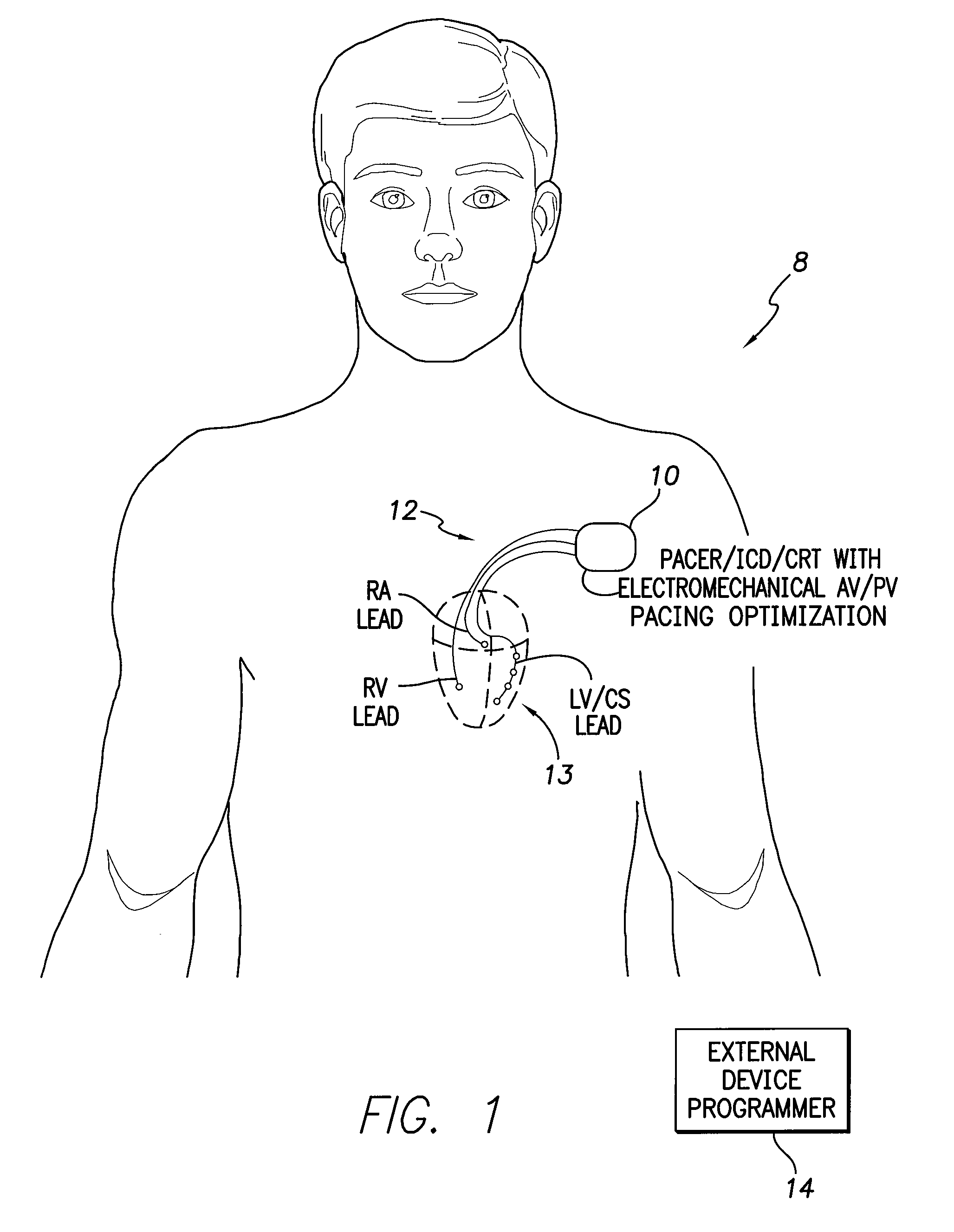 Systems and Methods for Determining Optimal Atrioventricular Pacing Delays Based on Cardiomechanical Delays