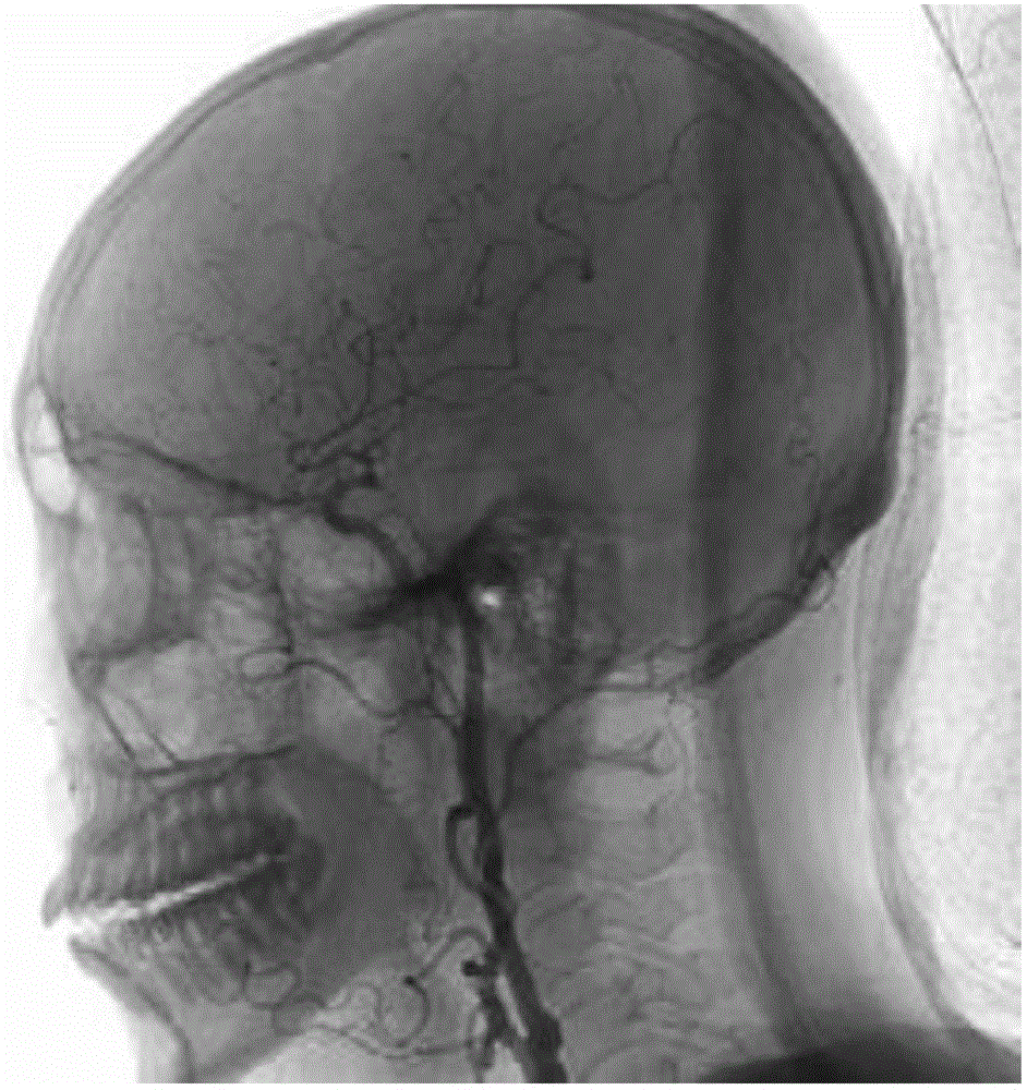 DSA vascular image segmentation method based on SIFT feature point clustering and Boolean different operation